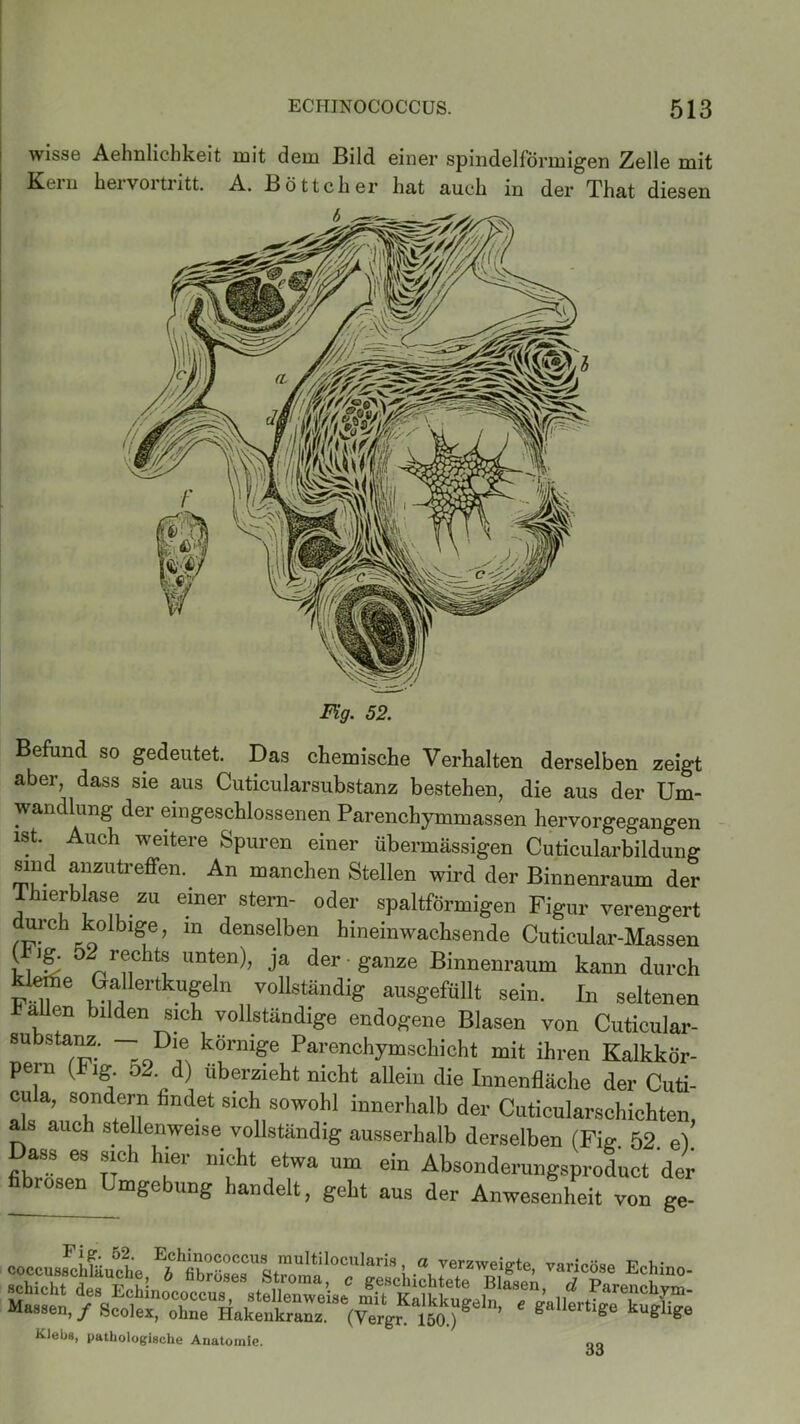 wisse Aehnlicbkeit mit dem Bild einer spindelförmigen Zelle mit Kern hervortritt. A. Böttcher hat auch in der That diesen Fig. 52. Befund so gedeutet. Das chemische Verhalten derselben zeigt aber, dass sie aus Cuticularsubstanz bestehen, die aus der Um- Wandlung der eingeschlossenen Parenchymmassen hervorgegangen ist Auch weitere Spuren einer übermässigen Cuticularbildung sind anzutreffen. An manchen Stellen wird der Binnenraum der Thierblase zu einer Stern- oder spaltförmigen Figur verengert ™ denselben hineinwachsende Cuticular-Massen l 1,‘S 52,,r?.C lt“ lmten)> ja der ganze Binnenraum kann durch kletfte Gallertkugeln vollständig ausgefüllt sein. In seltenen hallen bilden sich vollständige endogene Blasen von Cuticular- substanz. — Die körnige Parenchymschicht mit ihren Kalkkör- pern (Fig. o2. d) uberzieht nicht allein die Innenfläche der Cuti- cula, sondern findet sich sowohl innerhalb der Cuticularschichten als auch stellenweise vollständig ausserhalb derselben (Fig. 52 e) Dass es sich hier nicht etwa um ein Absonderungsproduct der fibrösen Lmgebung handelt, geht aus der Anwesenheit von ge- „ FJ?/. 5'?' Echinococcus multilocularis, a verzweie-te virinhw coccusschlauche, b fibröses Strnrm n ,• ;erzV®1gle> 'ancose Echino- Klebs, pathologische Anatomie. gg