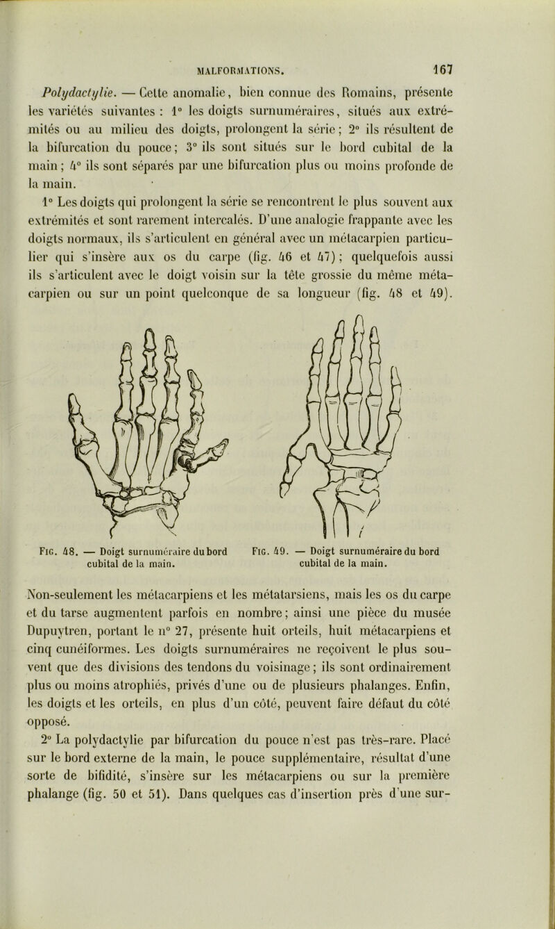 Polydactïjlie. —Celte anomalie, bien connue des Romains, présente les variétés suivantes: 1° les doigts surnuméraires, situés aux extré- mités ou au milieu des doigts, prolongent la série ; 2° ils résultent de la bifurcation du pouce ; 3“ ils sont situés sur le bord cubital de la main ; 4° ils sont séparés par une bifurcation plus ou moins [)rofonde de la main. 1° Les doigts qui prolongent la série se rencontrent le plus souvent aux extrémités et sont rarement intercalés. D’une analogie frappante avec les doigts normaux, ils s’articulent en général avec un métacarpien particu- lier qui s’insère aux os du carpe (fig. Zi6 et Zi7); quelquefois aussi ils s’articulent avec le doigt voisin sur la tête grossie du même méta- carpien ou sur un point quelconque de sa longueur (fig. kS et ^9). Fig. 48. — Doigt surnuméraire du bord cubital de la main. Fig. 49. — Doigt surnuméraire du bord cubital de la main. Non-seulement les métacarpiens et les métatarsiens, mais les os du carpe et du tarse augmentent parfois en nombre ; ainsi une pièce du musée Dupuytren, portant le n° 27, présente huit orteils, huit métacarpiens et cinq cunéiformes. Les doigts surnuméraires ne reçoivent le plus sou- vent que des divisions des tendons du voisinage ; ils sont ordinairement plus ou moins atrophiés, privés d’une ou de plusieurs phalanges. Enfin, les doigts et les orteils, en plus d’un côté, peuvent faire défaut du côté opposé. 2“ La polydactylie par bifurcation du pouce n’est pas très-rare. Placé sur le bord externe de la main, le pouce supplémentaire, résultat d’une sorte de bifidité, s’insère sur les métacarpiens ou sur la première phalange (fig. 50 et 51). Dans quelques cas d’insertion près d’une sur-