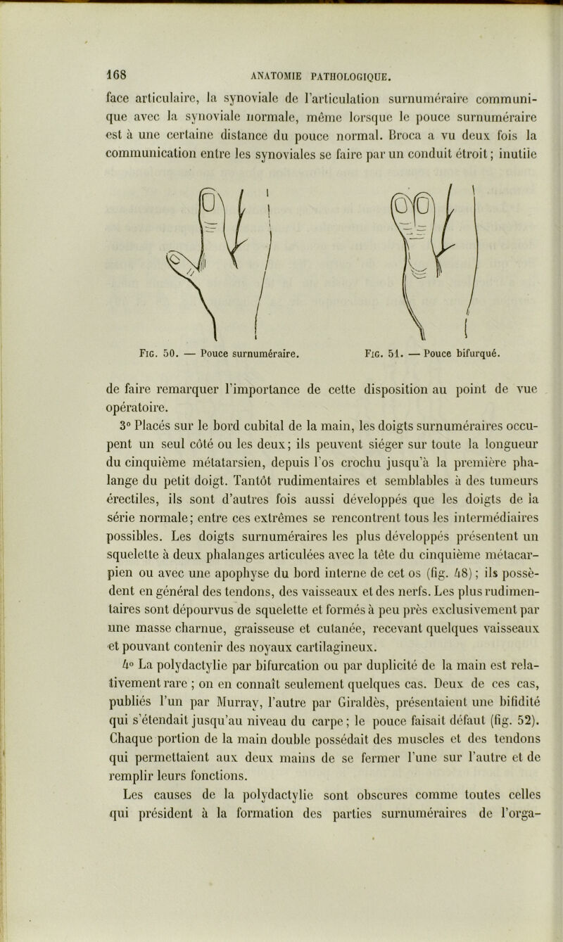 face articulaire, la synoviale de l’articulation surnuméraire communi- que avec la synoviale normale, même lorsque le pouce surnuméraire est à une certaine distance du pouce normal. Broca a vu deux fois la communication entre les synoviales se faire par un conduit étroit ; inutile de faire remarquer l’importance de cette disposition au point de vue opératoire. 3° Placés sur le bord cubital de la main, les doigts surnuméraires occu- pent un seul côté ou les deux; ils peuvent siéger sur toute la longueur du cinquième métatarsien, depuis l’os crochu jusqu’à la première pha- lange du petit doigt. Tantôt rudimentaires et semblables à des tumeurs érectiles, ils sont d’autres fois aussi développés que les doigts de la série normale ; entre ces extrêmes se rencontrent tous les intermédiaires possibles. Les doigts surnuméraires les plus développés présentent un squelette à deux phalanges articulées avec la tête du cinquième métacar- pien ou avec une apophyse du bord interne de cet os (fig. à8) ; ils possè- dent en général des tendons, des vaisseaux et des nerfs. Les plus rudimen- taires sont dépourvus de squelette et formés à peu près exclusivement par une masse charnue, graisseuse et cutanée, recevant quelques vaisseaux et pouvant contenir des noyaux cartilagineux. 4° La polydactylie par bifurcation ou par duplicité de la main est rela- tivement rare ; on en connaît seulement quelques cas. Deux de ces cas, publiés l’un par Murray, l’autre par Giraldès, présentaient une bifidité qui s’étendait jusqu’au niveau du carpe ; le pouce faisait défaut (fig. 52). Chaque portion de la main double possédait des muscles et des tendons qui permettaient aux deux mains de se fermer l’une sur l’autre et de remplir leurs fonctions. Les causes de la polydactylie sont obscures comme toutes celles qui président à la formation des parties surnuméraires de l’orga- Fig. 50. — Pouce surnuméraire. Fig. 51. — Pouce bifurqué.