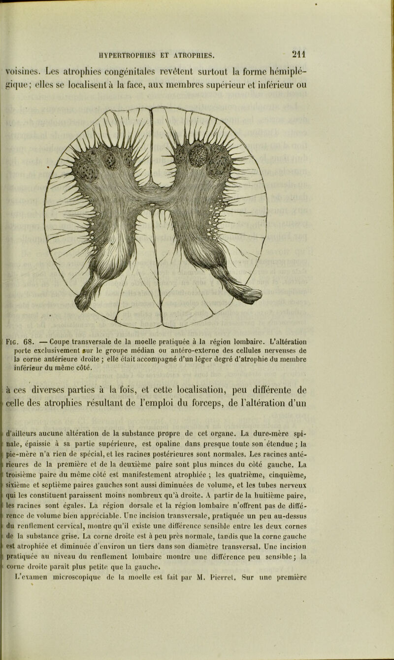 voisines. Les atrophies congénitales revêtent surtout la forme hémiplé- gique; elles se localisent à la face, aux membres supérieur et inférieur ou ) Fig. 68. —Coupe transversale de la moelle pratiquée à la région lombaire. L’altération : porte exclusivement sur le groupe médian ou antéro-externe des cellules nerveuses de la corne antérieure droite ; elle était accompagné d’un léger degré d’atrophie du membre j inférieur du même côté. I à ces diverses parties à la fois, et cette localisation, peu différente de celle des atrophies résultant de l’emploi du forceps, de l’altération d’un d’ailleurs aucune altération de la substance propre de cet organe. La dure-mère spi- nale, épaissie à sa partie supérieure, est opaline dans presque toute son étendue ; la pie-mère n’a rien de spécial, et les racines postérieures sont normales. Les racines anté- ! Heures de la première et de la deuxième paire sont plus minces du côté gauche. La troisième paire du même côté est manifestement atrophiée ; les quatrième, cinquième, sixième et septième paires gauches sont aussi diminuées de volume, et les tubes nerveux qui les constituent paraissent moins nombreux qu’à droite. A partir de la huitième paire, les racines sont égales. La région dorsale et la région lombaire n’offrent pas de diffé- rence de volume bien appréciable. Une incision transversale, pratiquée un peu au-dessus du renflement cervical, montre qu’il existe une différence sensible entre les deux cornes de la substance grise. La corne droite est à peu près normale, tandis que la corne gauche est atrophiée et diminuée d’environ un tiers dans son diamètre transversal. Une incision pratiquée au niveau du renflement lombaire montre une différence peu sensible; la corne droite parait plus petite que la gauche. L’examen microscopique de la moelle est fait par M. Licrrel. Sur une première