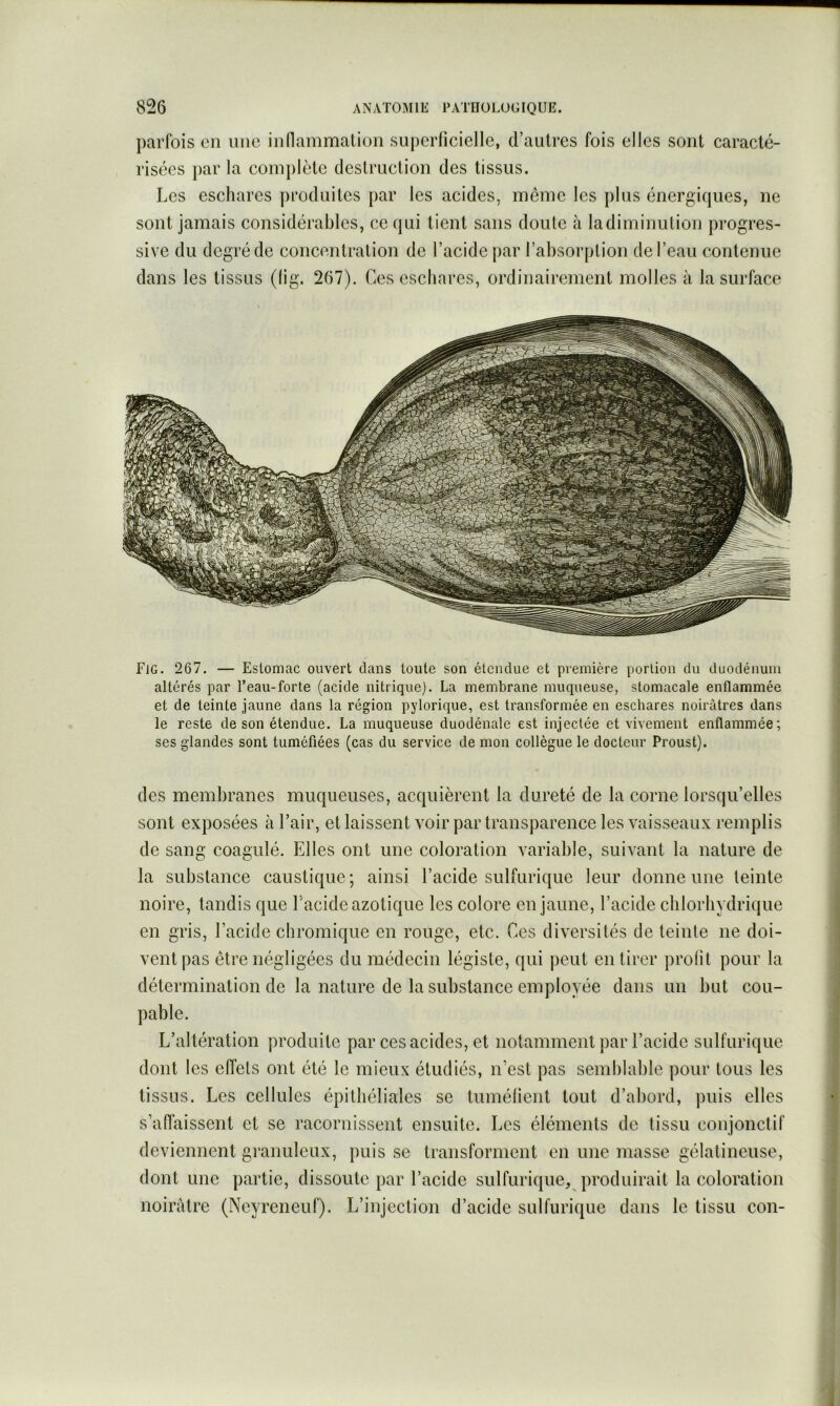 parfois on une inflammation superficielle, d’autres fois elles sont caracté- risées par la comjilète destruction des tissus. Les eschares produites par les acides, même les plus énergiques, ne sont jamais considérables, ce qui tient sans doute à ladiminution progres- sive du degré de concentration de l’acide par l’absorption de l’eau contenue dans les tissus (lig. 267). Ces eschares, ordinairement molles cà la surface Fjg. 267. — Estomac ouvert dans toute son étendue et première portion du duodénum altérés par l’eau-forte (acide nitrique). La membrane muqueuse, stomacale enflammée et de teinte jaune dans la région pylorique, est transformée en eschares noirâtres dans le reste de son étendue. La muqueuse duodénale est injectée et vivement enflammée; ses glandes sont tuméfiées (cas du service de mon collègue le docteur Proust). des membranes muqueuses, acquièrent la dureté de la corne lorsqu’elles sont exposées à l’air, et laissent voir par transparence les vaisseaux remplis de sang coagulé. Elles ont une coloration variable, suivant la nature de la substance caustique; ainsi l’acide sulfurique leur donne une teinte noire, tandis que l’acide azotique les colore en jaune, l’acide chlorhydrique en gris, l’acide chromique en rouge, etc. Ces diversités de teinte ne doi- vent pas être négligées du médecin légiste, qui peut en tirer profit pour la détermination de la nature de la substance employée dans un but cou- pable. L’altération produite par ces acides, et notamment par l’acide sulfurique dont les effets ont été le mieux étudiés, n’est pas semblable pour tous les tissus. Les cellules épithéliales se tuméfient tout d’abord, puis elles s’affaissent et se racornissent ensuite. Les éléments de tissu conjonctif deviennent granuleux, puis se transforment en une masse gélatineuse, dont une partie, dissoute par l’acide sulfurique, produirait la coloration noirâtre (Ncyreneuf). L’injection d’acide sulfurique dans le tissu con-