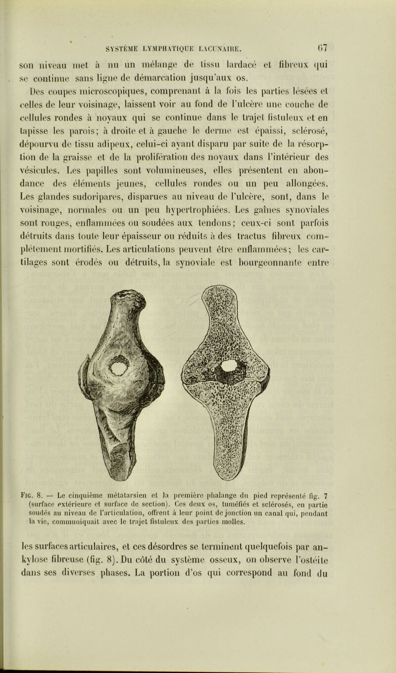 SYSTÈME LYMPIIATigUK LACCNAIUK. 1)7 son niveau met à nn iin mélange de lissn lardacé et ni)renx. (jui se continue sans ligne de démarcation jusqu’aux: os. Des coupes microsco|)i(|ues, comprenant à la lois les parties lésées et celles de leur voisinage, laissent voir au Tond de l’ulcèrc une couche de cellules rondes à noyaux qui se continue dans le trajet lisluleux et en tapisse les parois; à droite et à gauche le dernu' est épaissi, sclérosé, dépourvu de tissu adipeux, celui-ci ayant disparu par suite de la résorp- tion de la graisse et de la prolifération des noyaux dans l’intérieur des vésicules. Les papilles sont volumineuses, elles présentent en abon- dance des éléments jeunes, cellules rondes ou un peu allongées. Les glandes sudoripares, disparues au niveau de l’ulcère, sont, dans le voisinage, normales ou un peu hypertrophiées. Les gaines synoviales sont rouges, enllammées ou soudées aux tendons ; ceux-ci sont parfois détruits dans toute leur épaisseur ou réduits à des tractus lihreux com- plélement mortifiés. Les articulations peuvent être enflammées; les car- tilages sont érodés ou détruits, la synoviale est bourgeonnante entre Fig. 8. — Le cinquième métatarsien et ta première phalange du pied représenté fig. 7 (surface extérieure et surface de section). Ces deux os, tuméfiés et sclérosés, en partie soudés au niveau de l’articulation, offrent à leur point de jonction un canal qui, pendant la vie, communiquait avec le trajet fistuleux des parties molles. les surfaces articulaires, et ces désordres se terminent quelquefois par an- kylosé fibreuse (fig. 8). Du côté du système osseux, on observe l’ostéile dans ses diverses phases. La portion d’os qui correspond au fond du