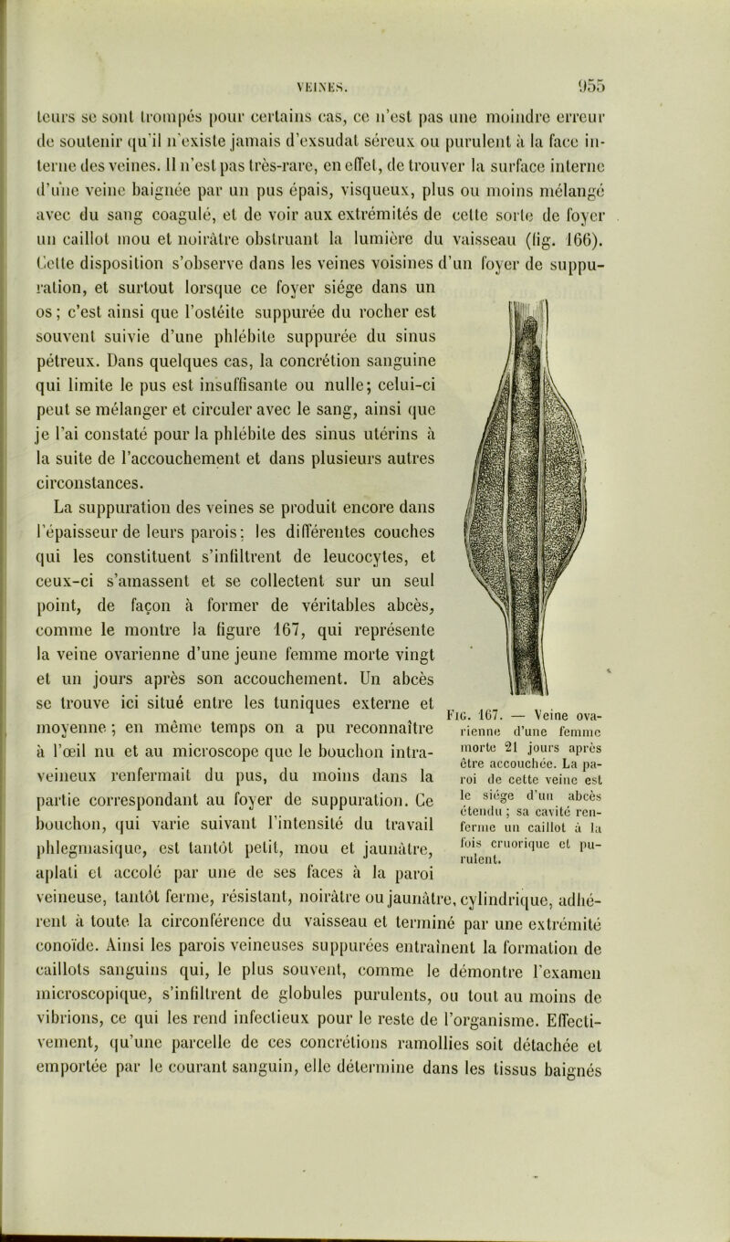 leurs se sont Iroinpés [)Our eertaiiis cas, ce ii’est pas une moindre erreur (le soulenir ([u’il n'exisle jamais d’exsudal séreux ou purulent à la face in- terne des veines. Il n’est pas très-rare, en eiïel, de trouver la surface interne d’une veine baignée par un pus épais, visciueux, plus ou moins mélangé avec du sang coagulé, et de voir aux extrémités de celte sorte de foyer un caillot mou et noirâtre obstruant la lumière du vaisseau (lig. 166). Celte disposition s’observe dans les veines voisines d’un foyer de suppu- ration, et surtout lorscjue ce foyer siège dans un os ; c’est ainsi que l’ostéite suppurée du rocher est souvent suivie d’une phlébite suppurée du sinus pétreux. Dans quelques cas, la concrétion sanguine qui limite le pus est insuffisante ou nulle; celui-ci peut se mélanger et circuler avec le sang, ainsi que je l’ai constaté pour la phlébite des sinus utérins à la suite de l’accouchement et dans plusieurs autres circonstances. La suppuration des veines se produit encore dans l’épaisseur de leurs parois ; les différentes couches qui les constituent s’infiltrent de leucocytes, et ceux-ci s’amassent et se collectent sur un seul point, de façon à former de véritables abcès, comme le montre la figure 167, qui représente la veine ovarienne d’une jeune femme morte vingt et un jours après son accouchement. Un abcès se trouve ici situé entre les tuniques externe et moyenne ; en même temps on a pu reconnaître à l’œil nu et au microscope que le bouchon intra- veineux renfermait du pus, du moins dans la partie correspondant au foyer de suppuration. Ce bouchon, qui varie suivant l’intensité du travail pblegmasiquo, est tantôt petit, mou et jaunâtre, aplati et accolé par une de ses faces à la paroi veineuse, tantôt ferme, résistant, noirâtre ou jaunâtre, cylindrique, adhé- rent à toute la circonférence du vaisseau et terminé par une extrémité conoïde. Ainsi les parois veineuses suppurées entraînent la formation de caillots sanguins qui, le plus souvent, comme le démontre l’examen microscopif[ue, s’infiltrent de globules purulents, on tout au moins de vibrions, ce qui les rend infectieux pour le reste de l’organisme. Effecli- vement, (ju’une parcelle de ces concrétions ramollies soit détachée et emportée par le courant sanguin, elle détermine dans les tissus baignés Fig. 167. Veine ova- rienne d’une femme morte 21 jours après être accouchée. La pa- roi de cette veine est le siège d’un abcès étendu ; sa cavité ren- ferme un caillot à la fois cruorique et pu- rulent.