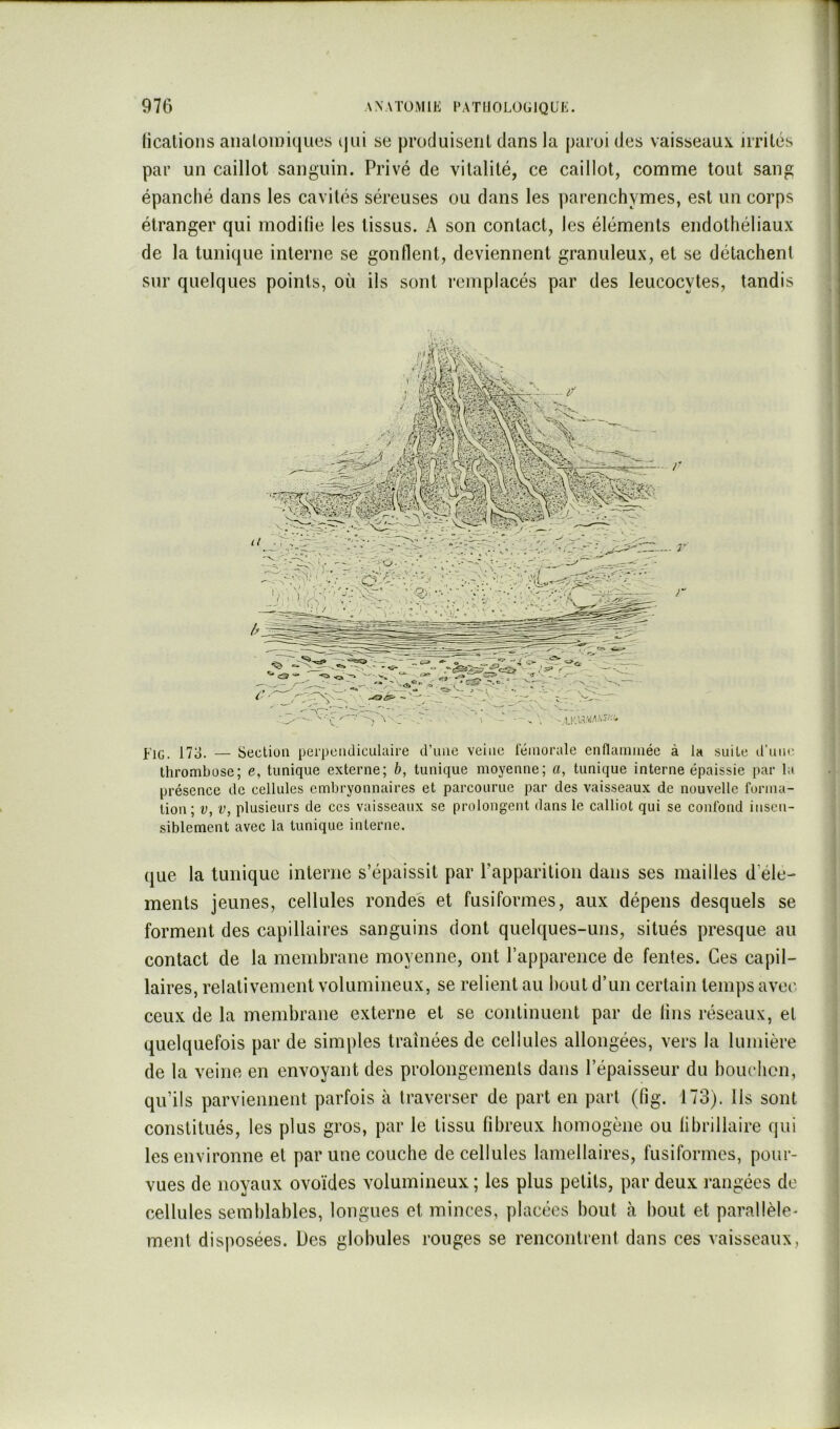 ticatioiis analoiHiques (lui se produisenl dans la paroi des vaisseaux, irrités par un caillot sanguin. Privé de vitalité, ce caillot, comme tout sang épanché dans les cavités séreuses ou dans les parenchymes, est un corps étranger qui modifie les tissus. A son contact, les éléments endothéliaux de la tunique interne se gonflent, deviennent granuleux, et se détachent sur quelques points, où ils sont l’emplacés par des leucocytes, tandis FiG. 17û. — Section peipeadiculaire d’une veine leinorale ennamniée à la suite d’uiu' thrombose; e, tunique externe; b, tunique moyenne; a, tunique interne épaissie par la présence de cellules embryonnaires et parcourue par des vaisseaux de nouvelle forma- tion; V, V, plusieurs de ces vaisseaux se prolongent dans le calliot qui se confond insen- siblement avec la tunique interne. que la tunique interne s’épaissit par l’apparition dans ses mailles d élé- ments jeunes, cellules rondes et fusiformes, aux dépens desquels se forment des capillaires sanguins dont quelques-uns, situés presque au contact de la membrane moyenne, ont l’apparence de fentes. Ces capil- laires, relativement volumineux, se relient au liout d’un certain temps avec ceux de la membrane externe et se continuent par de lins réseaux, et quelquefois par de simples traînées de cellules allongées, vers la lumière de la veine en envoyant des prolongements dans l’épaisseur du bouchon, qu’ils parviennent parfois à traverser de part en part ((ig. 173). Ils sont constitués, les plus gros, par le tissu fibreux homogène ou fibrillaire qui les environne et par une couche de cellules lamellaires, fusiformes, pour- vues de noyaux ovoïdes volumineux; les plus petits, par deux rangées de cellules semblables, longues et minces, placées bout à bout et parallèle- ment disposées. Des globules rouges se rencontrent dans ces vaisseaux,