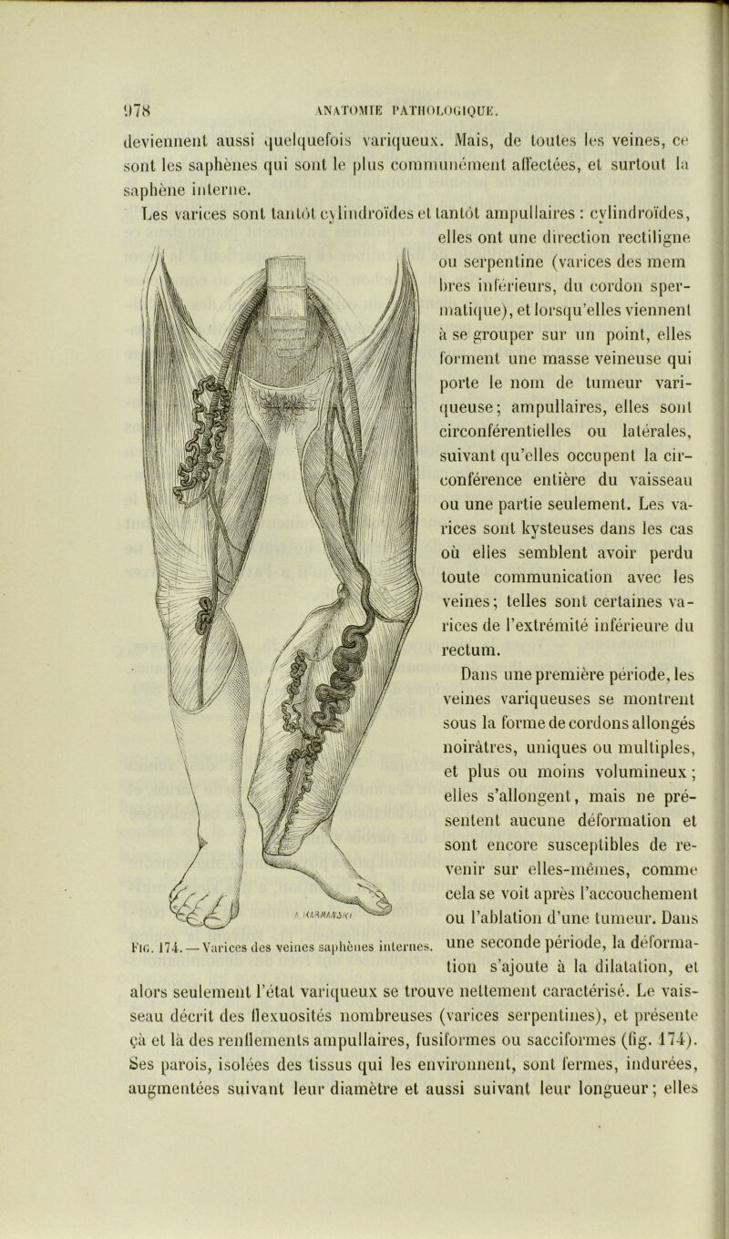ilevieniieiit aussi v|uelquefois variqueux. Mais, de toutes les veines, ce sont les saphènes qui sont le plus communément allectées, et surtout la saphène interne. Les varices sont tantôt c^lindroïdes et tantôt ampullaires : cylindroïdes, elles ont une direction rectiligne ou serpentine (varices des mem bres inférieurs, du cordon sper- mati({ue), et lorsqu’elles viennent à se grouper sur un point, elles forment une masse veineuse qui porte le nom de tumeur vari- queuse; ampullaires, elles sont circonférentielles ou latérales, suivant qu’elles occupent la cir- conférence entière du vaisseau ou une partie seulement. Les va- rices sont kysteuses dans les cas où elles semblent avoir perdu toute communication avec les veines; telles sont certaines va- rices de l’extrémité inférieure du rectum. Dans une première période, les veines variqueuses se montrent sous la forme de cordons allongés noirâtres, uniques ou multiples, et plus ou moins volumineux ; elles s’allongent, mais ne pré- sentent aucune déformation et sont encore susce[)tibles de re- venir sur elles-mêmes, comme cela se voit après l’accouchement ou l’ablation d’une tumeur. Dans une seconde période, la déforma- tion s’ajoute à la dilatation, el alors seulement l’état variqueux se trouve nettement caractérisé. Le vais- seau décrit des flexuosités nombreuses (varices serpentines), et présente çà et là des rendements ampullaires, fusiformes ou sacciformes (lig. 174). Ses parois, isolées des tissus qui les environnent, sont fermes, indurées, augmentées suivant leur diamètre et aussi suivant leur longueur; elles Fk;. 174. — Varices des veines saphènes inlernes.