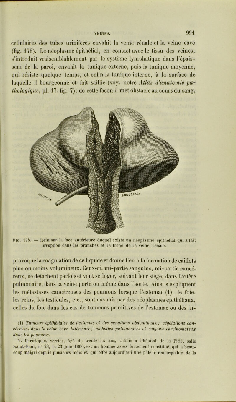 cellulaires des tubes urinifères envahit la veine rénale et la veine cave (fig. 178). Le néoplasme épithélial, en contact avec le tissu des veines, s’introduit vraisemhlahlement par le système lymphatique dans l’épais- seur de la paroi, envahit la tunique externe, puis la tunique moyenne, qui résiste quelque temps, et enlin la tunique interne, à la surface de laquelle il bourgeonne et fait saillie (voy. notre Atlas d'anatomie 'pa- thologique, pl. 17, fig. 7); de cette façon il met obstacle au cours du sang, Fig. 178. — Rein sur la face antérieure duquel existe un néoplasme épithélial qui a fait irruption dans les branches et le tronc de la veine rénale. provoque la coagulation de ce liquide et donne lieu à la formation de caillots plus ou moins volumineux. Ceux-ci, mi-partie sanguins, mi-partie cancé- reux, se détachent parfois et vont se loger, suivant leur siège, dans l’artère pulmonaire, dans la veine porte ou même dans l’aorte. Ainsi s’expliquent les métastases cancéreuses des poumons lorsque l’estomac (1), le foie, les reins, les testicules, etc., sont envahis par des néoplasmes épithéliaux, celles du foie dans les cas de tumeurs primitives de l’estomac ou des in- ^1) Tumeurs épithéliales de Teslomac et des ganglions abdominaux ; végétations can- céreuses dans la veine cave inférieure; embolies pulmonaires et nogaux carcinomateux dans les poumons. V. Christophe, verrier, âgé do trente-six ans, admis à l’iiôpital de la Pitié, salle Saint-Paul, n° 23, le 23 juin 1860, est un homme assez fortement constitué, qui a beau- coup maigri depuis plusieurs mois et qui offre aujourd’hui une pâleur remarquable de la