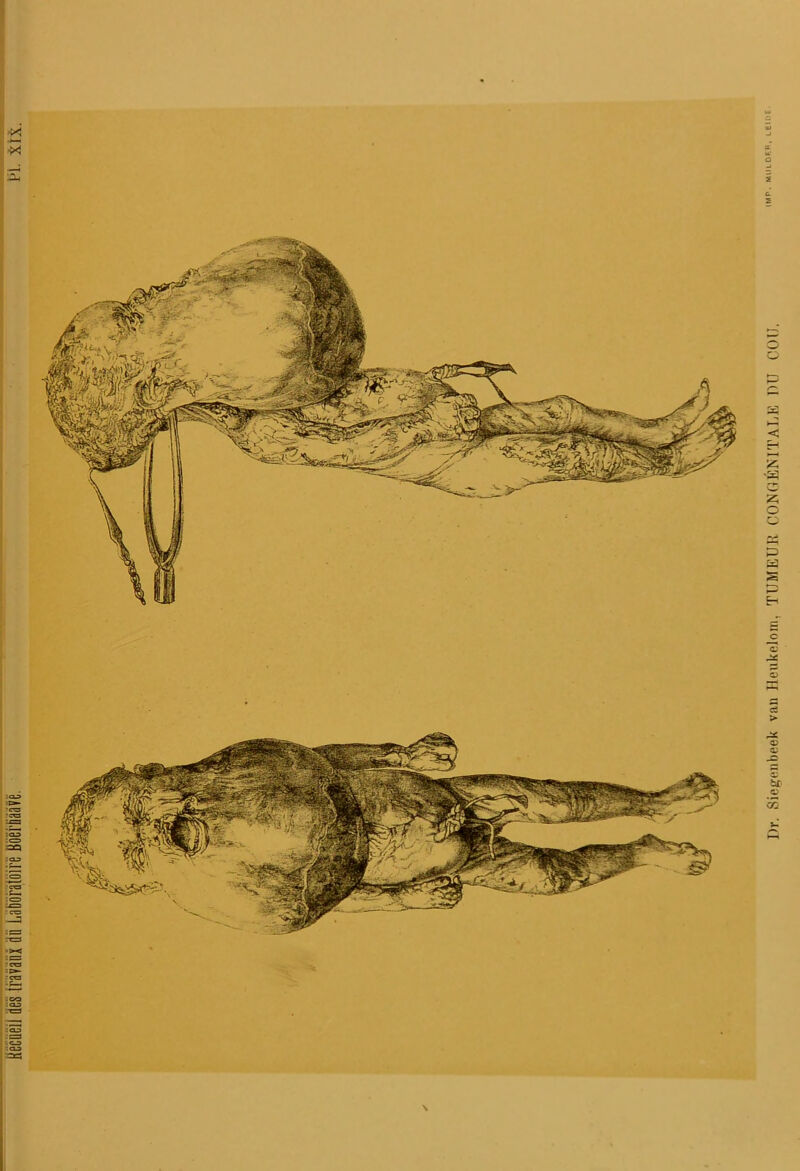 I)r. Siegenbeek van Heukelom, TUMEUR CONGÉNITALE DU COU.