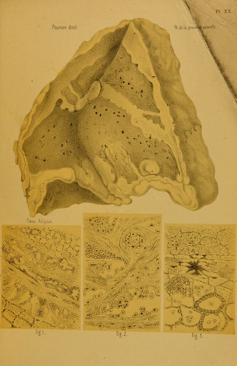 PI. XX % de la ^randiW naturelle Poumon droit W.'J Mil v,
