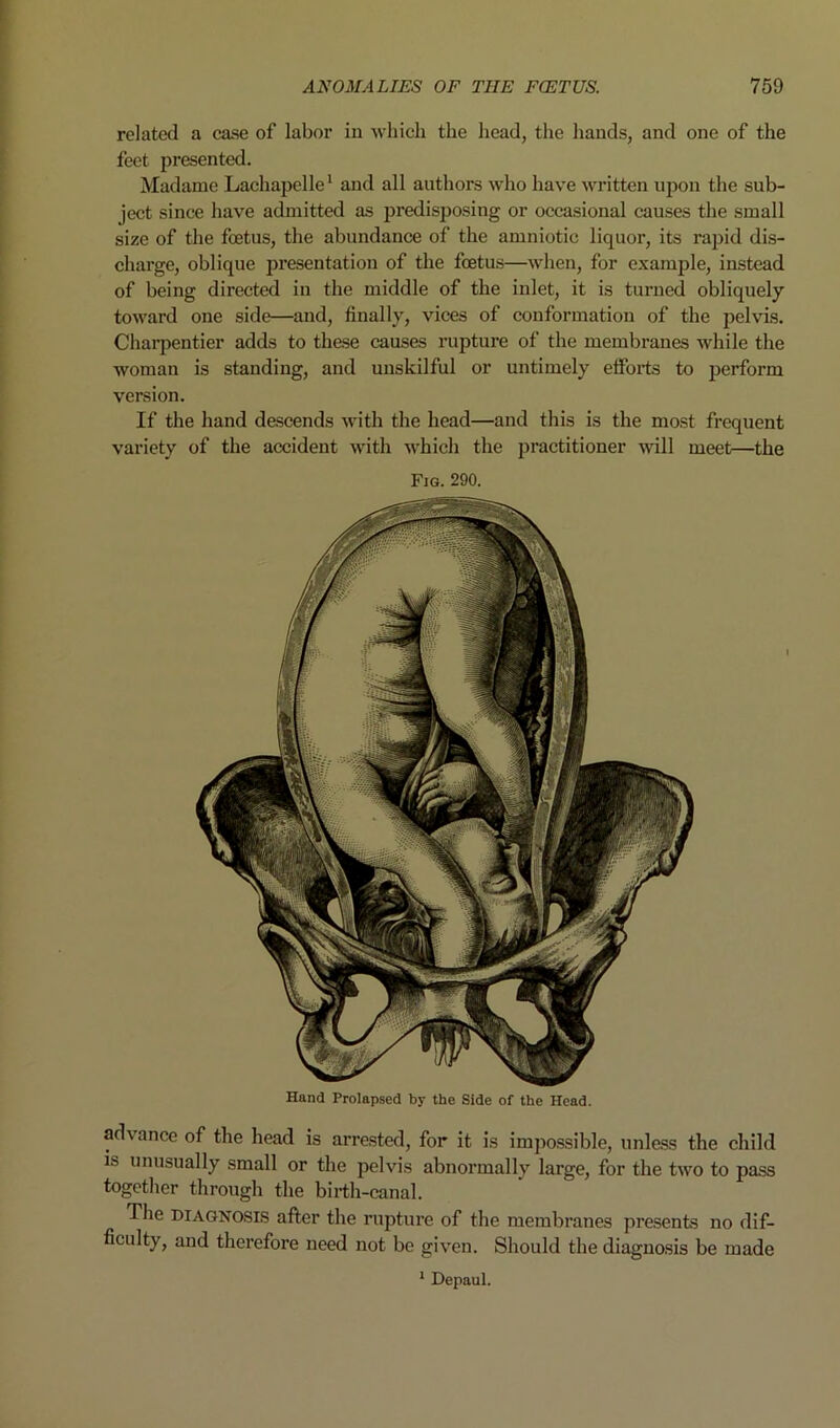 Hand Prolapsed by the Side of the Head. advance of the head is arrested, for it is impo.ssible, unless the child is unusually small or the pelvis abnormally large, for the two to pass togetlier through the birth-canal. The DIAGNOSIS after the rupture of the membranes presents no dif- ficulty, and therefore need not be given. Should the diagnosis be made * Depaul. related a case of labor in which the head, the hands, and one of the feet presented. Madame Lachapelle' and all authors who have written upon the sub- ject since have admitted as predisposing or occasional causes the small size of the foetus, the abundance of the amniotic liquor, its rapid dis- charge, oblique jn'esentation of the foetus—when, for example, instead of being directed in the middle of the inlet, it is turned obliquely toward one side—and, finally, vices of conformation of the pelvis. Chai-pentier adds to these causes rupture of the membranes while the woman is standing, and unskilful or untimely etfoi*ts to perform version. If the hand descends with the head—and this is the most frequent variety of the accident with which the practitioner mil meet—the Fjg. 290.