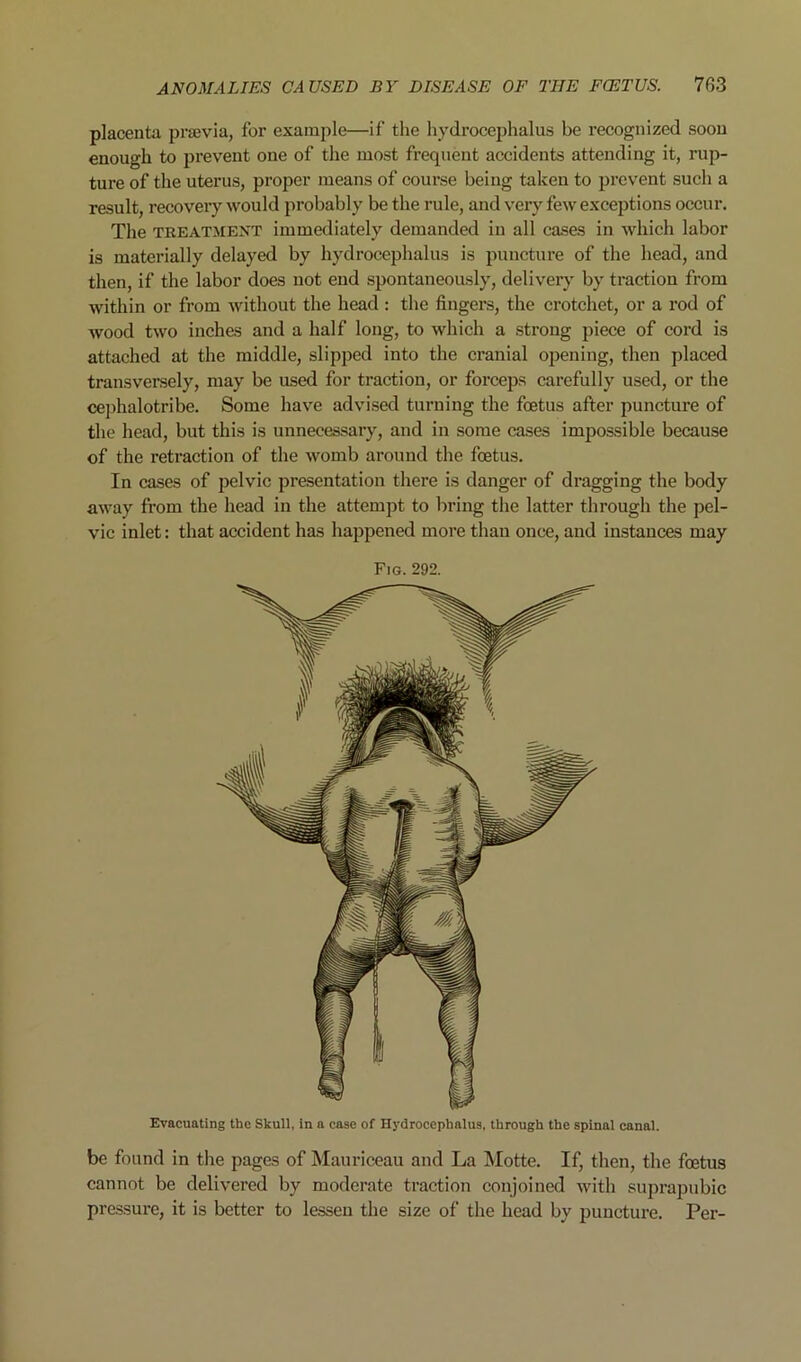 placenta pravia, for example—if the hydrocephalus be recognized soon enough to prevent one of the most frequent accidents attending it, rup- ture of the uterus, proper means of course being taken to prevent such a result, recovery would probably be the rule, and very few exceptions occur. The TREATMENT immediately demanded in all cases in which labor is materially delayed by hydrocephalus is puncture of the head, and then, if the labor does not end spontaneously, delivery by traction from within or from without the head : the fingers, the crotchet, or a rod of wood two inches and a half long, to which a strong piece of cord is attached at the middle, slipped into the cranial opening, then placed transversely, may be used for traction, or forceps carefully used, or the cej)halotribe. Some have advised turning the foetus after puncture of the head, but this is unnecessary, and in some cases impossible because of the retraction of the womb around the foetus. In cases of pelvic presentation there is danger of dragging the body away from the head in the attempt to bring the latter through the pel- vic inlet: that accident has happened more than once, and instances may Fig. 292. Evacuating the Skull, in a case of Hydrocephalus, through the spinal canal. be found in the pages of Mauriceau and La Motte. If, then, the foetus cannot be delivered by moderate traction conjoined with suprapubic pressure, it is better to lessen the size of the head by puncture. Per-