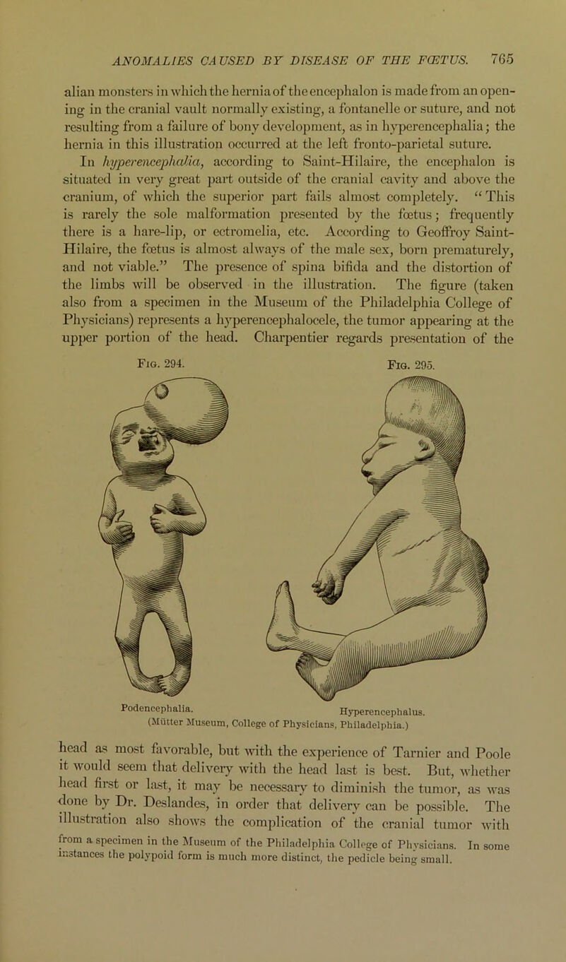 alian monsters i n which the hernia of the encephalon is made from an open- ing in the cranial vault normally existing, a fontanelle or suture, and not resulting from a failure of bony development, as in hyperencephalia; the hernia in this illustration occurred at the left fronto-parietal suture. In hyperencephalia, according to Saint-Hilaire, the encephalon is situated in very great part outside of the cranial cavity and above the cranium, of which the superior part fails almost completely. “ This is rarely the sole malformation presented by the foetus; frequently there is a hare-lip, or ectromelia, etc. According to Geoffroy Saint- Hilaire, the foetus is almost always of the male .sex, born jirematurely, and not viable.” The pre.sence of .spina bifida and the distortion of the limbs will be observed in the illustration. The figure (taken also from a specimen in the Museum of the Philadelphia College of Physicians) rejiresents a hyperencephalocele, the tumor appearing at the upper portion of the head. Charpentier regards presentation of the Fig. 294. Fig. 295. Podencephalia. (Mutter Maseum, Hyperencephalus. College of Physicians, Philadelphia.) head as most favorable, but with the experience of Tarnier and Poole it would seem that delivery with the head last is be.st. But, whether head first or la.st, it may be necessaiy to dimini.sh the tumor, as was done by Dr. Deslandes, in order that delivery can be possible. The illustration also shows the complication of the cranial tumor with from a specimen in the Museum of the Pliiladelphia College of Physicians. In some instances the polypoid form is much more distinct, the pedicle being small.