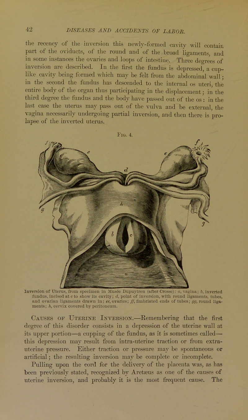 the recency of the inversion this newly-formed cavity will contain part of the oviducts, of the round and of the broad iigaments, and in some instances the ovaries and loops of intestine. Three degrees of inversion are described. In the first the fundus is depressed, a cup- like cavity being formed which may be felt from the abdominal wall; in the second the fundus has descended to the internal os uteri, the entire body of the organ thus participating in the displacement; in the third degree the fundus and the body have passed out of the os : in the last case the uterus may pass out of the vulva and be external, the vagina necessarily undergoing partial inversion, and then there is pro- lapse of the invei’ted uterus. Fig. 4. Inversion of Uterus, from specimen in Mus6e Dupuytren (after Crosse): a, vagina; 6, inverted fundus, incised at c to show its cavity; d, point of inversion, with round ligaments, tubes, and ovarian ligaments drawn in; ee, ovaries; ff, fimbriated ends of tubes; gg, round liga- ments; A, cervix covered by peritoneum. Causes of Uterine Inversion.—Remembering that the finst degree of this disorder consists in a depression of the uterine wall at its upper portion—a cupping of the fundus, as it is sometimes called— this depression may result from intra-uterine traetion or from extra- uterine pressure. Either traction or jiressure may be spontaneous or artificial; the resulting inversion may be complete or incomplete. Pulling upon the cord for the delivery of the placenta was, as has been previously stated, recognized by Areticus as one of the causes of uterine invereion, and probably it is the most frequent cau.se. The