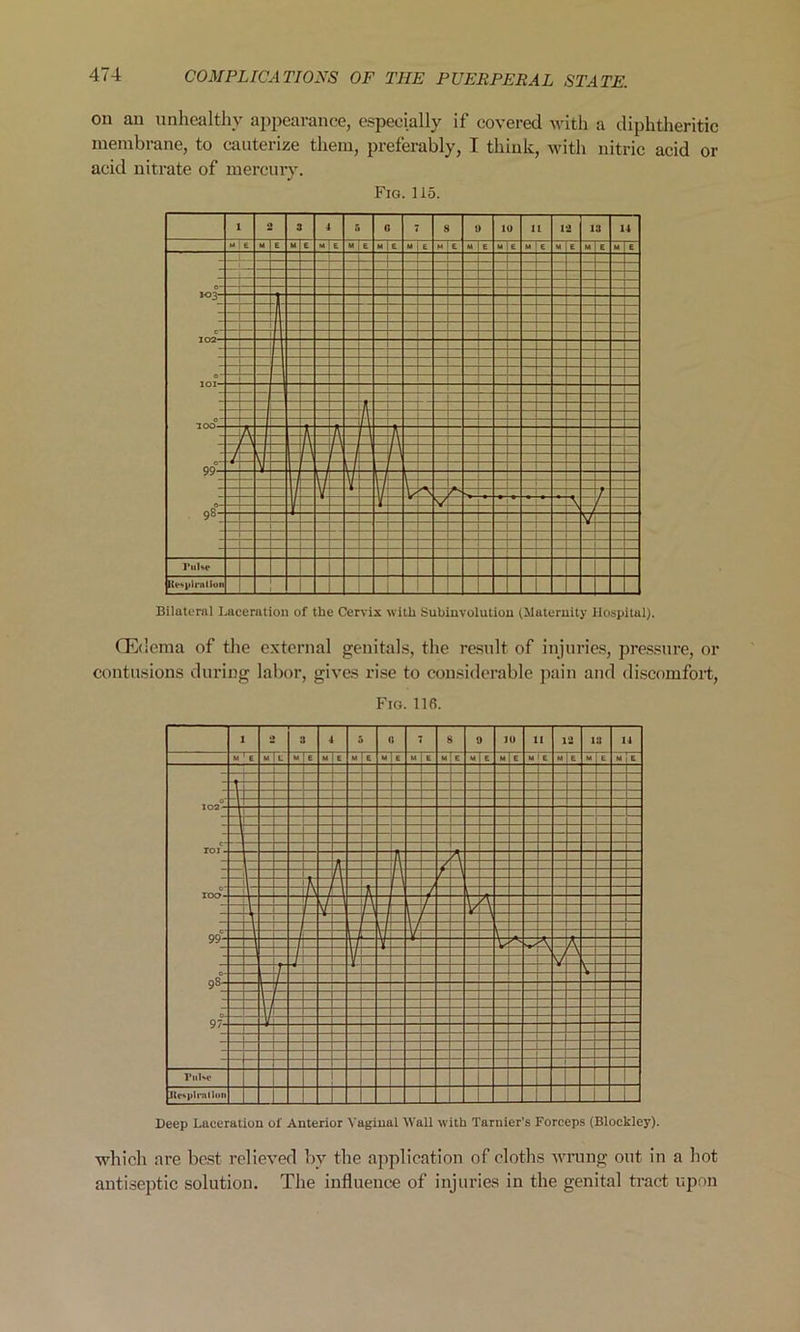 on an unhealthy appearance, especially if covered with a diphtheritic membrane, to cauterize them, preferably, I think, with nitric acid or acid nitrate of mercury. Fig. 115. Bilateral Laceration of the Cervix with Subinvolution (Maternity Hospital). (Edema of the external genitals, the result of injuries, pressure, or contusions during labor, gives rise to considerable pain and discomfort, Fig. 116. Deep Laceration of Anterior Vaginal Wall with Tarnier’s Forceps (Blockley). which are best relieved by the application of cloths wrung out in a hot antiseptic solution. The influence of injuries in the genital tract upon