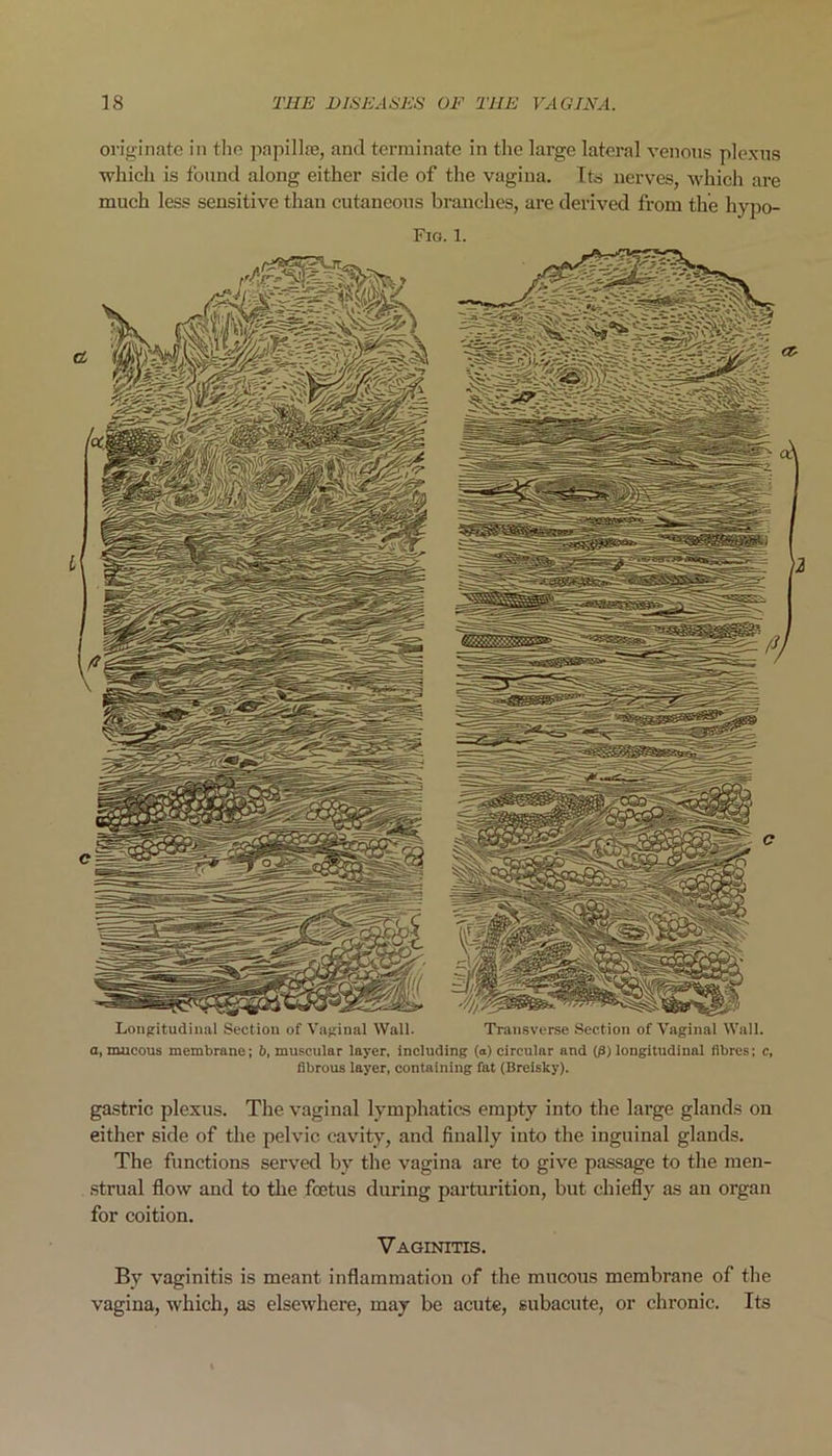 originate in the papillae, and terminate in the large lateral venous plexus which is found along either side of the vagina. Its nerves, which are much less sensitive than cutaneous branches, are derived from the hypo- Fig. 1. Longitudinal Section of Vaginal Wall. Transverse Section of Vaginal Wall, a, mucous membrane; 6, muscular layer, including (a) circular and (j3) longitudinal fibres: e, fibrous layer, containing fat (Breisky). gastric plexus. The vaginal lymphatics empty into the large glands on either side of the pelvic cavity, and finally into the inguinal glands. The functions served by the vagina are to give passage to the men- strual flow and to the foetus during parturition, but chiefly as an organ for coition. Vaginitis. By vaginitis is meant inflammation of the mucous membrane of the vagina, which, as elsewhere, may be acute, subacute, or chronic. Its