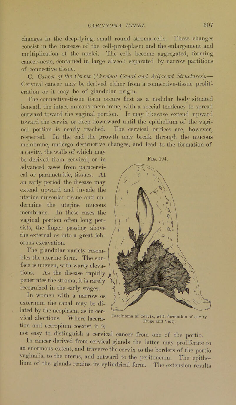 changes in the deep-lying, small round stroma-cells. These changes consist in the increase of the cell-protoplasm and the enlargement and multiplication of the nuclei. The cells become aggregated, forming cancer-nests, contained in large alveoli separated by narrow partitions of connective tissue. C. Cancer of the Cervix (Cervical Canal and Adjacent Structures).— Cervical cancer may be derived either from a connective-tissue prolif- eration or it may be of glandular origin. The connective-tissue form occurs first as a nodular body situated beneath the intact mucous membrane, with a special tendency to spread outward toward the vaginal portion. It may likewise extend upward toward the cervix or deep downward until the epithelium of the vagi- nal portion is nearly reached. The cervical orifices are, however, respected. In the end the growth may break through the mucous membrane, undergo destructive changes, and lead to the formation of a cavity, the walls of which may be derived from cervical, or in Fig. 194. advanced cases from paracervi- cal or parametritic, tissues. At an early period the disease may extend upward and invade the uterine muscular tissue and un- dermine the uterine mucous l membrane. In these cases the vaginal portion often long per- sists, the finger passing above the external os into a great ich- orous excavation. The glandular variety resem- bles the uterine form. The sur- face is uneven, with warty eleva- tions. As the disease rapidly penetrates the stroma, it is rarely recognized in the early stages. In women with a narrow os externum the canal may be di- lated by the neoplasm, as in cer- vical abortions. Where lacera- Carci,10ma of of cavity tion and ectropium coexist it is not easy to distinguish a cervical cancer from one of the portio. In cancer derived from cervical glands the latter may proliferate to an enormous extent, and traverse the cervix to the borders of the portio vaginalis, to the uterus, and outward to the peritoneum. The epithe- lium of the glands retains its cylindrical form. The extension results
