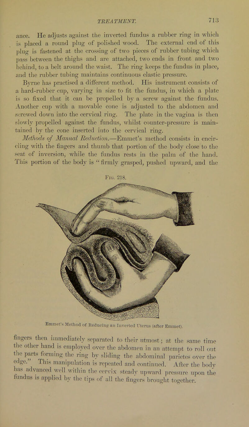 ance. He adjusts against the inverted fundus a rubber ring in which is placed a round plug of polished wood. The external end of this plug is fastened at the crossing of two pieces of rubber tubing which pass between the thighs and are attached, two ends in front and two behind, to a belt around the waist. The ring keeps the fundus in place, and the rubber tubing maintains continuous elastic pressure. Byrne has practised a different method. His instrument consists of a hard-rubber cup, varying in size to tit the fundus, in which a plate is so fixed that it can be propelled by a screw against the fundus. Another cup with a movable cone is adjusted to the abdomen and screwed down into the cervical ring. The plate in the vagina is then slowly propelled against the fundus, whilst counter-pressure is main- tained by the cone inserted into the cervical ring. Methods of Manual Reduction.—Emmet’s method consists in encir- cling with the fingers and thumb that portion of the body close to the seat of inversion, while the fundus rests in the palm of the hand. This portion of the body is “ firmly grasped, pushed upward, and the Fig. 218. Emmet’s Method of Reducing: an Inverted Uterus (after Emmet). fingers then immediately separated to their utmost; at the same time tbe other hand is employed over the abdomen in an attempt to roll out the parts forming the ring bv sliding the abdominal parietes over the edge.” This manipulation is repeated and continued. After the body las advanced well within the cervix steady upward pressure upon the fundus is applied by the tips of all the fingers brought together.