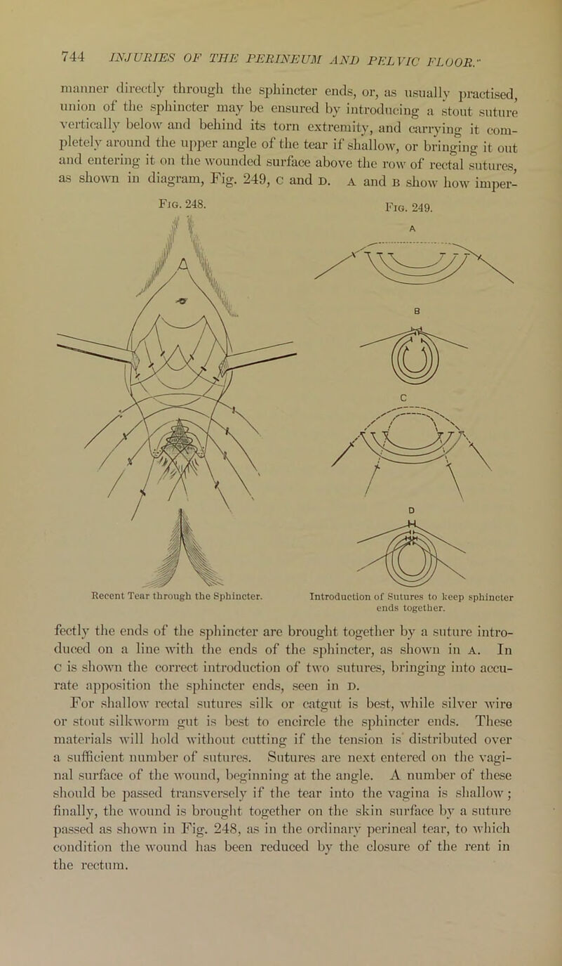 manner directly through the sphincter ends, or, as usually practised, union of the sphincter may be ensured by introducing a stout suture vertically below and behind its torn extremity, and carrying it com- pletely around the upper angle of the tear if shallow, or bringing it out and entering it on the wounded surface above the row of rectal sutures as shown in diagram, Fig. 249, c and D. a and b show how irnper- Fjg. 248. Fig. 249. ends together. fectly the ends of the sphincter are brought together by a suture intro- duced on a line with the ends of the sphincter, as shown in A. In c is shown the correct introduction of two sutures, bringing into accu- rate apposition the sphincter ends, seen in d. For shallow rectal sutures silk or catgut is best, while silver wire or stout silkworm gut is best to encircle the sphincter ends. These materials will hold without cutting if the tension is distributed over a sufficient number of sutures. Sutures are next entered on the vagi- nal surface of the wound, beginning at the angle. A number of these should be passed transversely if the tear into the vagina is shallow; finally, the wound is brought together on the skin surface by a suture passed as shown in Fig. 248, as in the ordinary perineal tear, to which condition the wound has been reduced by the closure of the rent in the rectum.