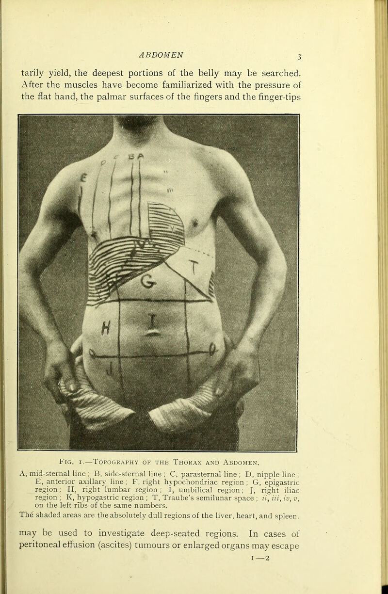 tarily yield, the deepest portions of the belly may be searched. After the muscles have become familiarized with the pressure of the flat hand, the palmar surfaces of the fingers and the finger-tips Fig. I.—Topography of the Thorax and Abdomen. A, mid-sternal line ; B, side-sternal line ; C, parasternal line ; D, nipple line ; E, anterior axillary line ; F, right hypochondriac region ; G, epigastric region; H, right lumbar region; I, umbilical region; J, right iliac region ; K, hypogastric region ; T, Traube's semilunar space ; ii. Hi, iv, v, on the left ribs of the same numbers. The shaded areas are the absolutely dull regions of the liver, heart, and spleen. may be used to investigate deep-seated regions. In cases of peritoneal effusion (ascites) tumours or enlarged organs may escape I—2 I