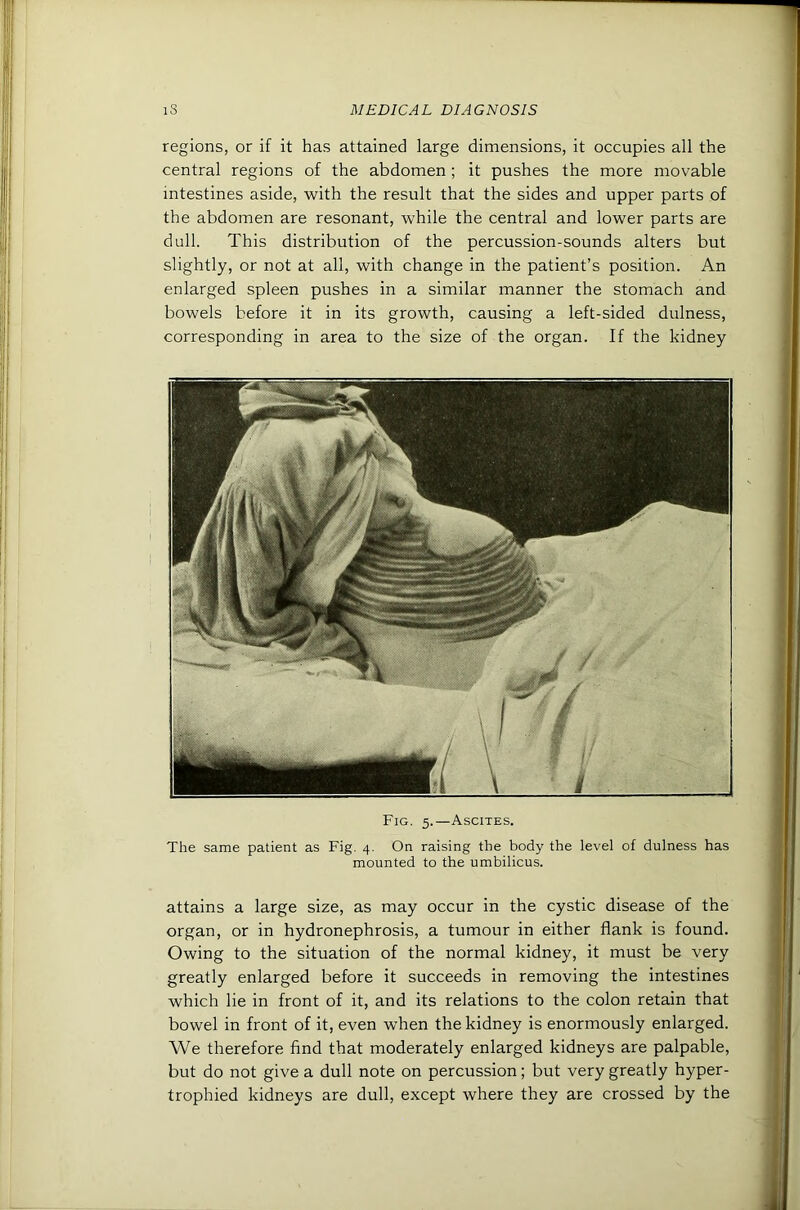 regions, or if it has attained large dimensions, it occupies all the central regions of the abdomen ; it pushes the more movable intestines aside, with the result that the sides and upper parts of the abdomen are resonant, while the central and lower parts are dull. This distribution of the percussion-sounds alters but slightly, or not at all, with change in the patient’s position. An enlarged spleen pushes in a similar manner the stomach and bowels before it in its growth, causing a left-sided dulness, corresponding in area to the size of the organ. If the kidney Fig. 5.—Ascites. The same patient as Fig. 4. On raising the body the level of dulness has mounted to the umbilicus. attains a large size, as may occur in the cystic disease of the organ, or in hydronephrosis, a tumour in either flank is found. Owing to the situation of the normal kidney, it must be very greatly enlarged before it succeeds in removing the intestines which lie in front of it, and its relations to the colon retain that bowel in front of it, even when the kidney is enormously enlarged. We therefore find that moderately enlarged kidneys are palpable, but do not give a dull note on percussion; but very greatly hyper- trophied kidneys are dull, except where they are crossed by the