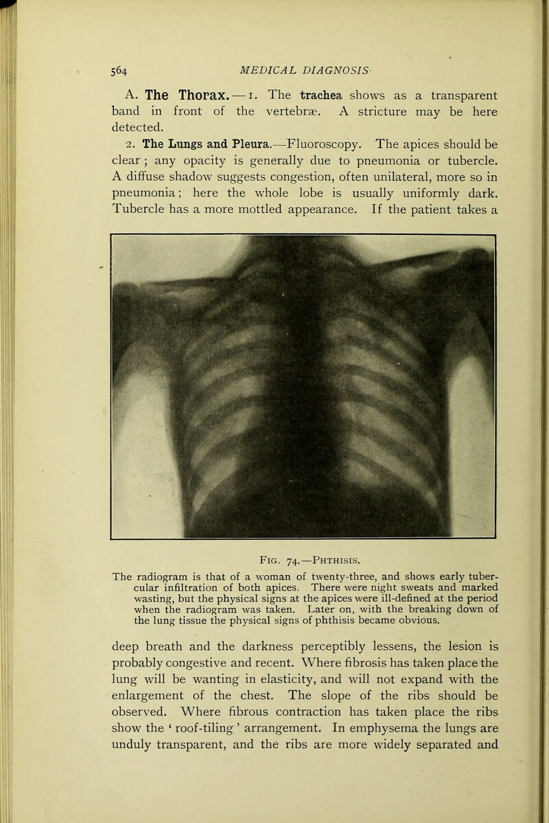 A. The Thorax. — I. The trachea shows as a transparent band in front of the vertebrae. A stricture may be here detected. 2. The Lungs and Pleura.—Fluoroscopy. The apices should be clear ; any opacity is generally due to pneumonia or tubercle. A diffuse shadow suggests congestion, often unilateral, more so in pneumonia; here the whole lobe is usually uniformly dark. Tubercle has a more mottled appearance. If the patient takes a Fig. 74.—Phthisis. The radiogram is that of a woman of twenty-three, and shows early tuber- cular infiltration of both apices. There were night sweats and marked wasting, but the physical signs at the apices were ill-defined at the period when the radiogram was taken. Later on, with the breaking down of the lung tissue the physical signs of phthisis became obvious. deep breath and the darkness perceptibly lessens, the lesion is probably congestive and recent. Where fibrosis has taken place the lung will be wanting in elasticity, and will not expand with the enlargement of the chest. The slope of the ribs should be observed. Where fibrous contraction has taken place the ribs show the ‘ roof-tiling ’ arrangement. In emphysema the lungs are unduly transparent, and the ribs are more widely separated and