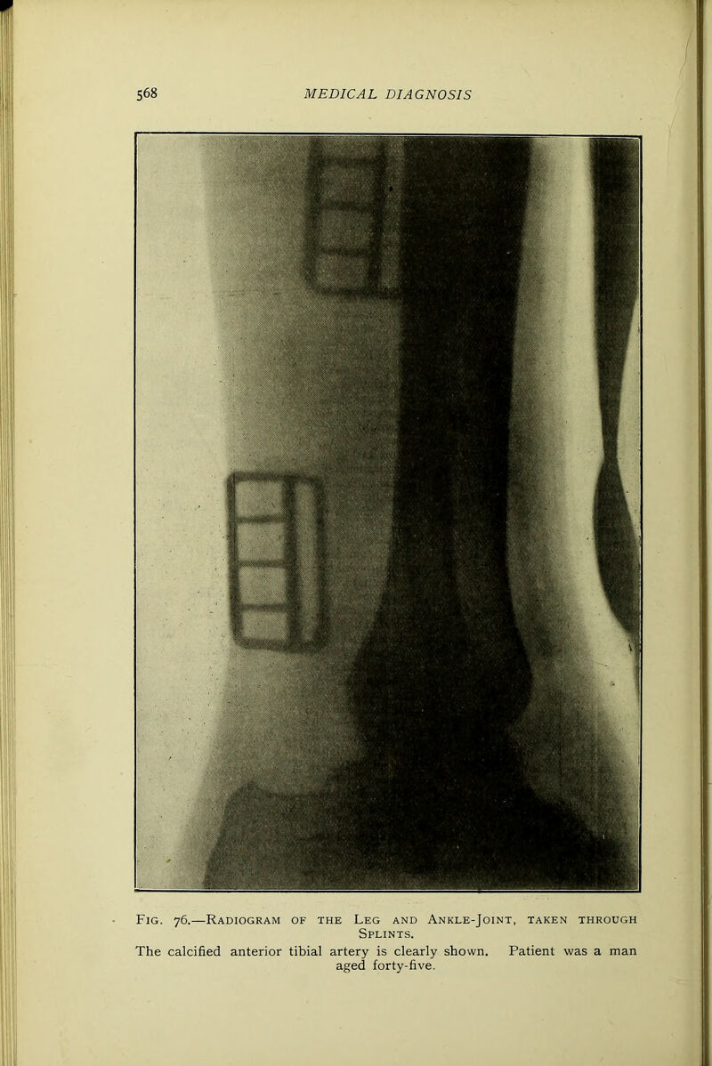 Fig. 76.—Radiogram of the Leg and Ankle-Joint, taken through Splints. The calcified anterior tibial artery is clearly shown. Patient was a man aged forty-five.