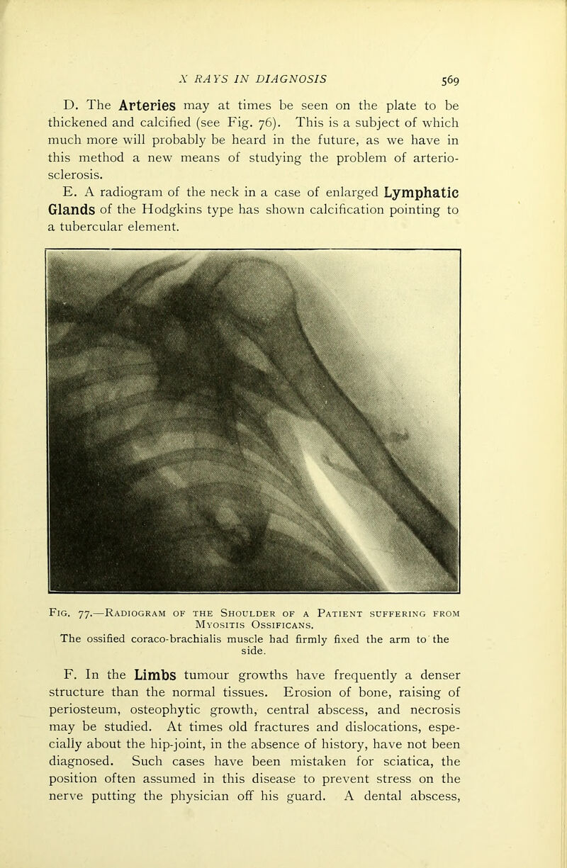 D. The ArtGPiGS may at times be seen on the plate to be thickened and calcified (see Fig. 76). This is a subject of which much more will probably be heard in the future, as we have in this method a new means of studying the problem of arterio- sclerosis. E. A radiogram of the neck in a case of enlarged Lymphatic Glands of the Hodgkins type has showm calcification pointing to a tubercular element. Fig. 77.—Radiogram of the Shoulder of a Patient suffering from Myositis Ossificans. The ossified coraco-brachialis muscle had firmly fixed the arm to the side. F. In the Limbs tumour growths have frequently a denser structure than the normal tissues. Erosion of bone, raising of periosteum, osteophytic growth, central abscess, and necrosis may be studied. At times old fractures and dislocations, espe- cially about the hip-joint, in the absence of history, have not been diagnosed. Such cases have been mistaken for sciatica, the position often assumed in this disease to prevent stress on the nerve putting the physician off his guard. A dental abscess.