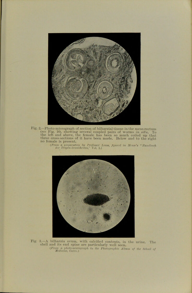 l' Fig. 2.—Plioto-mici’ograpli of section of bilharzial tissue in the meso-rectuni {sec Fig. 16), sliowing several coupled pairs of worms in situ. To the left and above, the female has been so much coiled up that three cross-sections of it have been made. Below and to the right i no female is present.  j (From a p?vparatio7? hy Professor Looss, figured in Mnise’s TTai^dbueh I (Ur Tropen-Ierankheiten, Vul. 1.) i Fig 3.—A bilharzia ovum, with calcified contents, in the urine. The shell and its end spine are particularly well seen. (Fi'om a photo-micrograph in the. Photographic Aihum of the School of Medicine, Cairo.) -99!