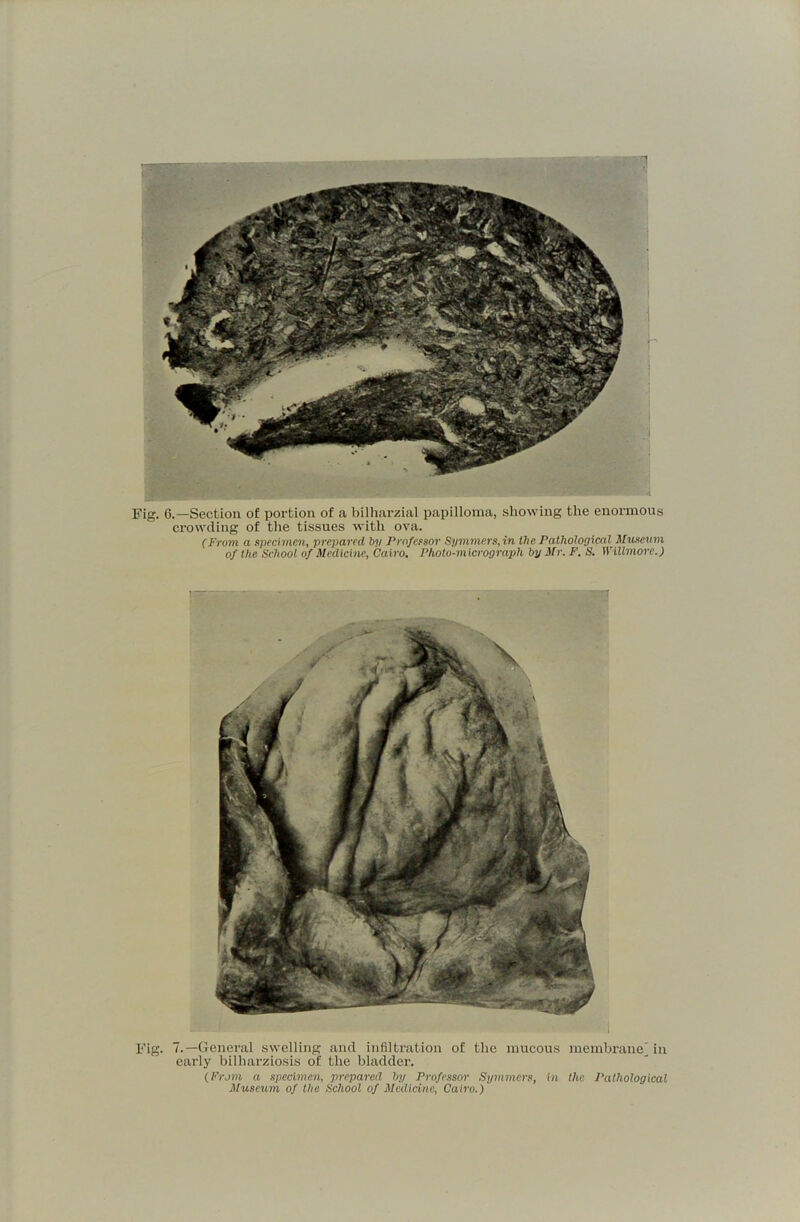 —! Fig. 6.—Section of portion of a bilharzial papilloma, showing the enormous crowding of the tissues with ova. (From a specimen, prepared by Professor Symmers,in the Pathological Museum of the School of Medicine, Cairo. Photo-micrograph by Mr. F. S. Willmore.) Fig. 7.—Genei'al swelling and infiltration of the mucous membraneMn early bilharziosis of the bladder. (From a specimen, prepared by Professor Symmers, in the Pathological Museum of the School of Medicine, Cairo.)