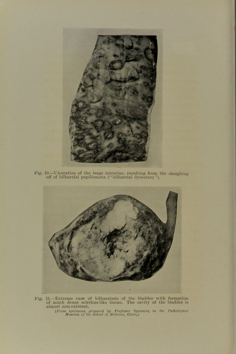 * . . Fig. 11.—Exti’eme case of bilharziosi.s of the bladder -witli formation of much dense scirrhus-like tissue. The cavity of tlie bladder is almost non-existent. (From specimens, prepared bp Professor F!ymmers, in the Pathological Museum of the School of Medicine, Cairo.) Fig. 10.—Ulceration of the large intestine, resulting from the sloughing off of bilharzial papillomata (“ bilharzial dysentery ”).