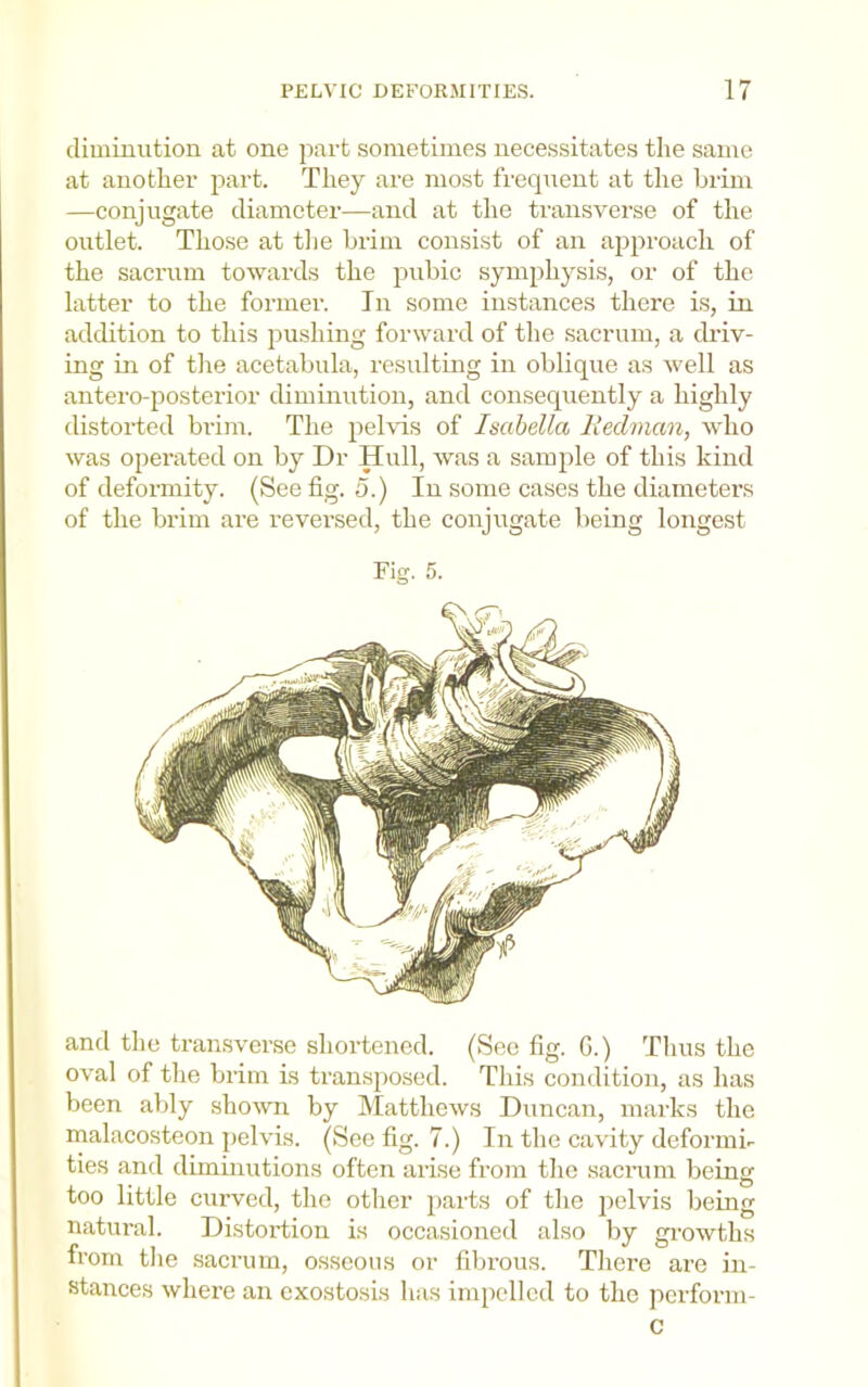 diminution at one part sometimes necessitates the same at another part. They are most frequent at the brim —conjugate diameter—and at the transverse of the outlet. Those at tiie brim consist of an approach of the sacrum towards the pubic symphysis, or of the latter to the former. In some instances there is, in addition to this pushing forward of the sacrum, a driv- ing in of tlie acetabula, resulting in oblique as well as antero-posterior diminution, and consequently a highly distorted brim. The pelvis of Isabella lledman, who was operated on by Dr Hull, was a sample of this kind of deformity. (See fig. 5.) In some cases the diametens of the brim are reversed, the conjugate being longest Fig. 5. and the transverse shortened. (See fig. G.) Thus the oval of the brim is transposed. This condition, as has been ably shown by Matthews Duncan, marks the malacosteon pelvis. (See fig. 7.) In the cavity deformi- ties and diminutions often arise from the sacnim being too little curved, the other parts of the pelvis being natural. Distortion is occasioned also by ginwths from the .sacrum, osseous or fibrous. There are in- stances where an exostosis has impelled to the perform-