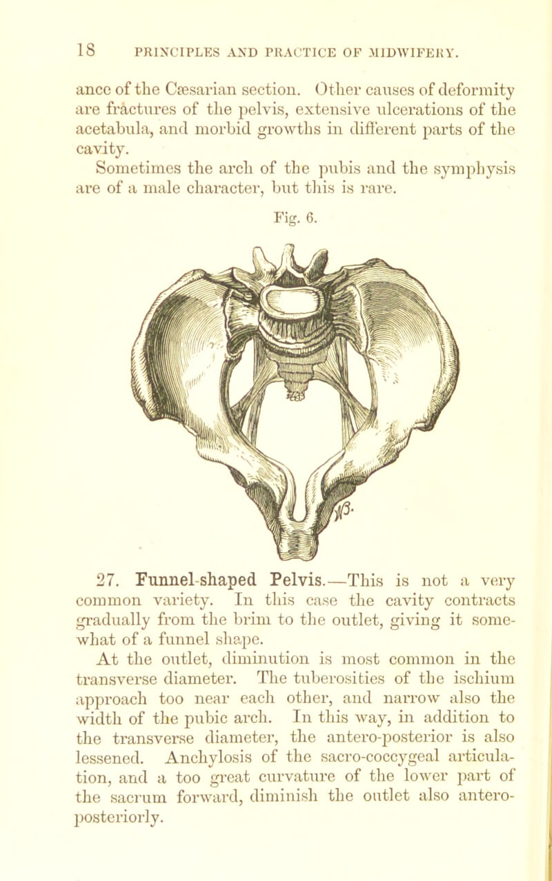 IS ancc of the Ciesavian section. (3tliev causes of deformity are fractures of the ^lelvis, extensive ulcerations of the acetabula, and morbid growths in different jiarts of the cavity. Sometimes the arch of the jmbis and the symphysi.s are of a male character, but this is rare. Fig. 6. 27. Funnel-shaped Pelvis.—This is not a very common variety. In this case the cavity contracts gradually from the brim to the outlet, giving it some- what of a funnel shape. At the outlet, dimuiutioii is most common in the transverse diameter. The tuberosities of the ischium approach too near each other, and narrow also the width of the pubic arch. In this way, in addition to the transverse diameter, the antero-posterior is also lessened. Anchylosis of the sacro-coccygeal articula- tion, and a too gi’eat curvature of the lower part of the sacrum forward, diminish the outlet also antero- ])Osteriorly.