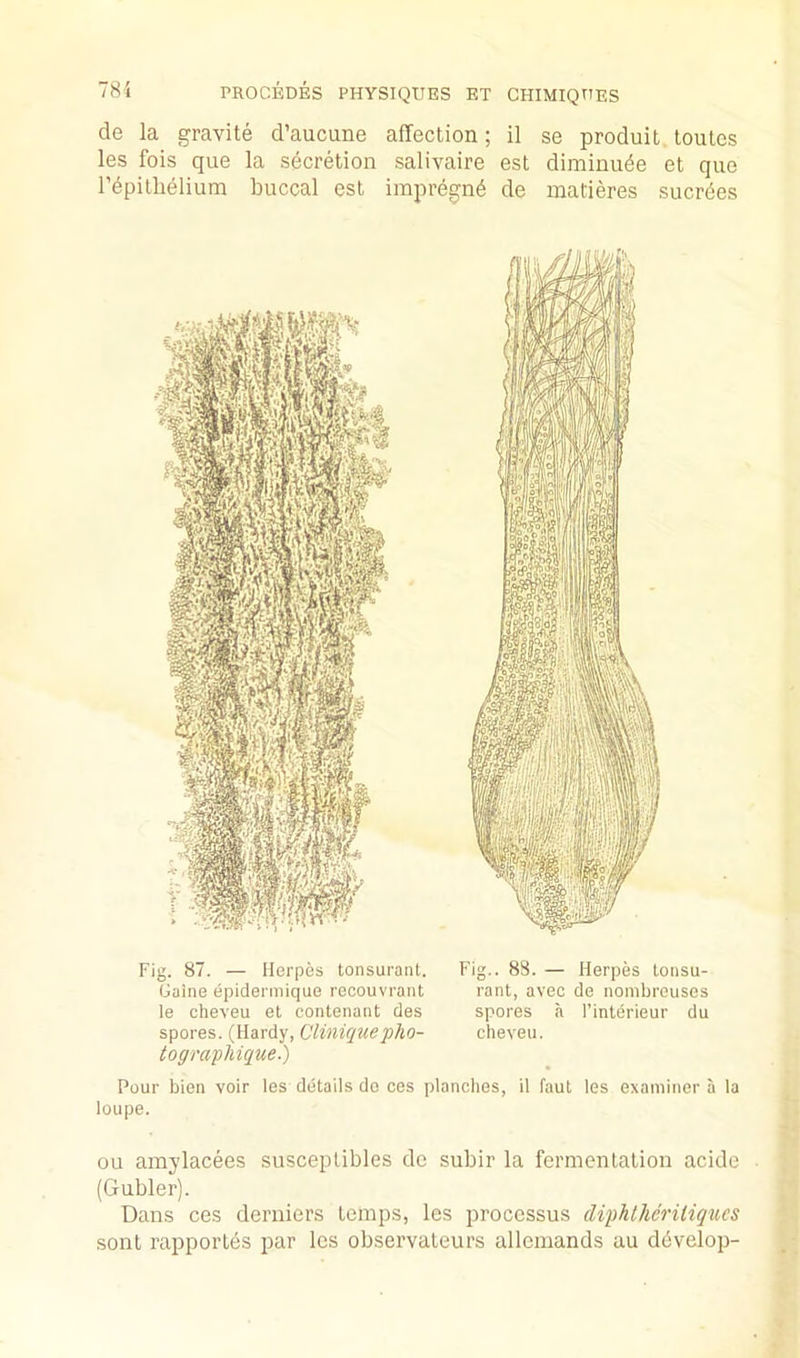 de la gravite d’aucune affection; il se produit toutes les fois que la secretion salivaire est diminude et que rdpitlielium buccal est impregnd de matieres sucrdes Fig. 87. — Herpes tonsuraiit. Game epidermique recouvrant le cheveu el contenaiit des spores. (Hardy, Cliniquepho- tograpMque.) Fig.. 88. — Herpes lonsu- rant, avec de nombrouses spores a I’interieur du cheveu. Pour bien voir les details do ces planches, il faut les examiner a la loupe. ou amylacees susceptibles de subir la fermentation acide (Gubler). Dans ces derniers temps, les processus diphtheriliques sont rapportes par les observateurs allcmands au ddvelop-