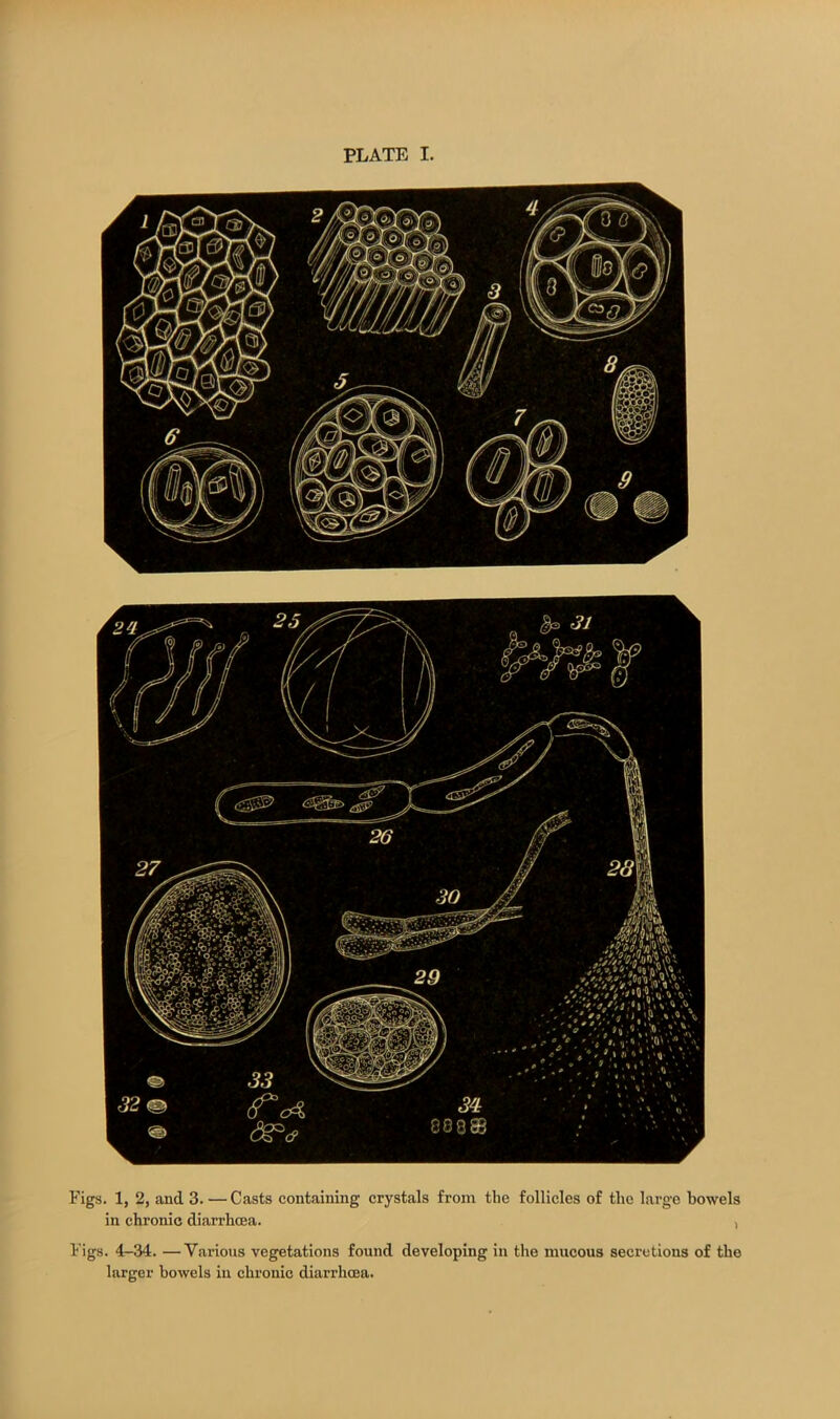 Figs. 1, 2, and 3. — Casts containing crystals from the follicles of the large bowels in chronic diarrhoea. , Figs. 4-34. —Various vegetations found developing in the mucous secretions of the larger bowels in chronic diarrhoea.