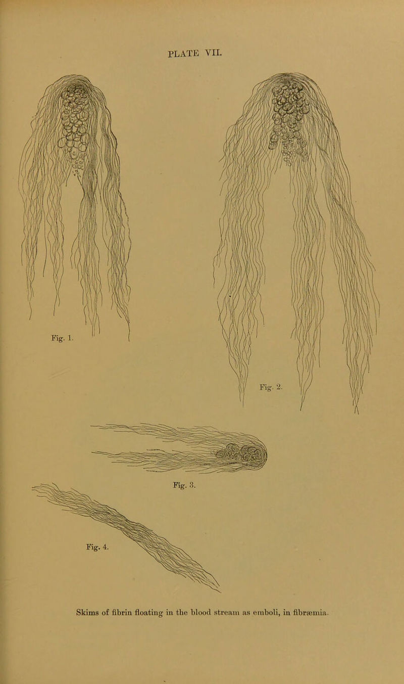 Skims of fibrin floating in the blood stream as emboli, in fibrsemia.