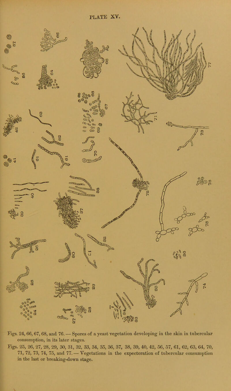 Figs. 24, 66, 67, 68, and 76. — Spores of a yeast vegetation developing in tlie skin in tubercular consumption, in its later stages. Figs. 25, 26, 27, 28, 29, 30, 31, 32, 33, 34, 35, 36, 37, 38, 39, 40, 42, 56, 57, 61, 62, 63, 64, 70, 71, 72, 73, 74, 75, and 77. — Vegetations in the expectoration of tubercular consumption in the last or breaking-down stage.