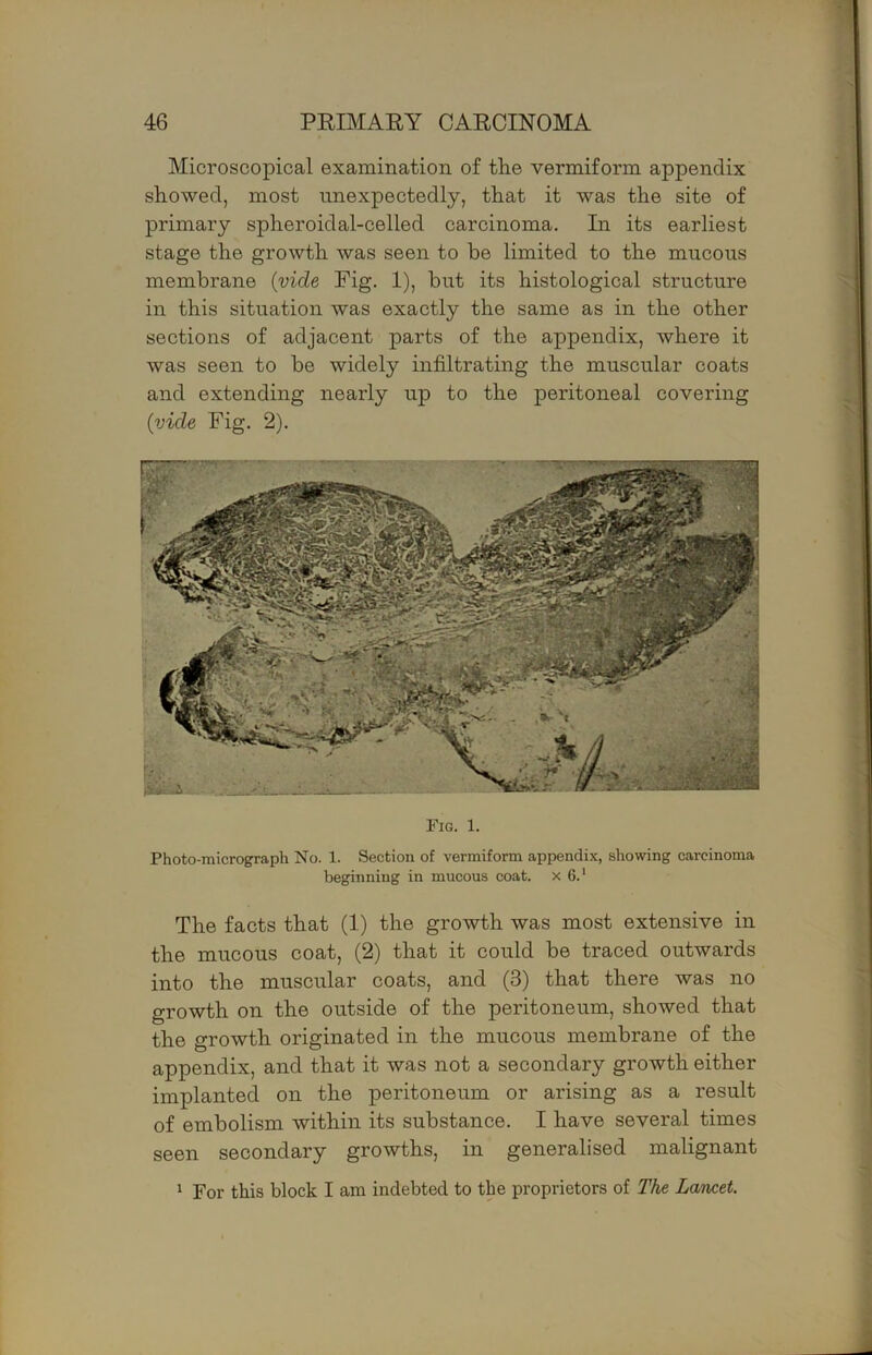 Microscopical examination of the vermiform appendix showed, most unexpectedly, that it was the site of primary spheroidal-celled carcinoma. In its earliest stage the growth was seen to be limited to the mucous membrane {vide Fig. 1), but its histological structure in this situation was exactly the same as in the other sections of adjacent parts of the appendix, where it was seen to be widely infiltrating the muscular coats and extending; nearly up to the peritoneal covering {vide Fig. 2). Fig. 1. Photo-micrograph No. 1. Section of vermiform appendix, showing carcinoma beginning in mucous coat, x 6.‘ The facts that (1) the growth was most extensive in the mucous coat, (2) that it could be traced outwards into the muscular coats, and (3) that there was no growth on the outside of the peritoneum, showed that the growth originated in the mucous membrane of the appendix, and that it was not a secondary growth either implanted on the peritoneum or arising as a result of embolism within its substance. I have several times seen secondary growths, in generalised malignant