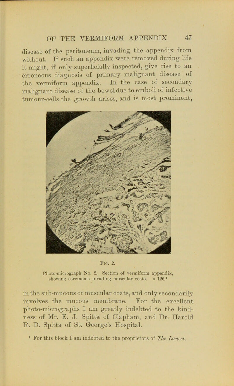 disease of the peritoneum, invading the appendix from without. If such an appendix were removed during life it might, if only superficially inspected, give rise to an erroneous diagnosis of primary malignant disease of the vermiform appendix. In the case of secondary malignant disease of the bowel due to emboli of infective tumour-cells the growth arises, and is most prominent, Fig. 2. Photo-micrograph No. 2. Section of vermiform appendix, showing carcinoma invading muscular coats, x 126. ‘ in the sub-mucous or muscular coats, and only secondarily involves the mucous membrane. For the excellent photo-micrographs I am greatly indebted to the kind- ness of Mr. E. J. Spitta of Clapham, and Dr. Harold R. D. Spitta of St. George’s Hospital.