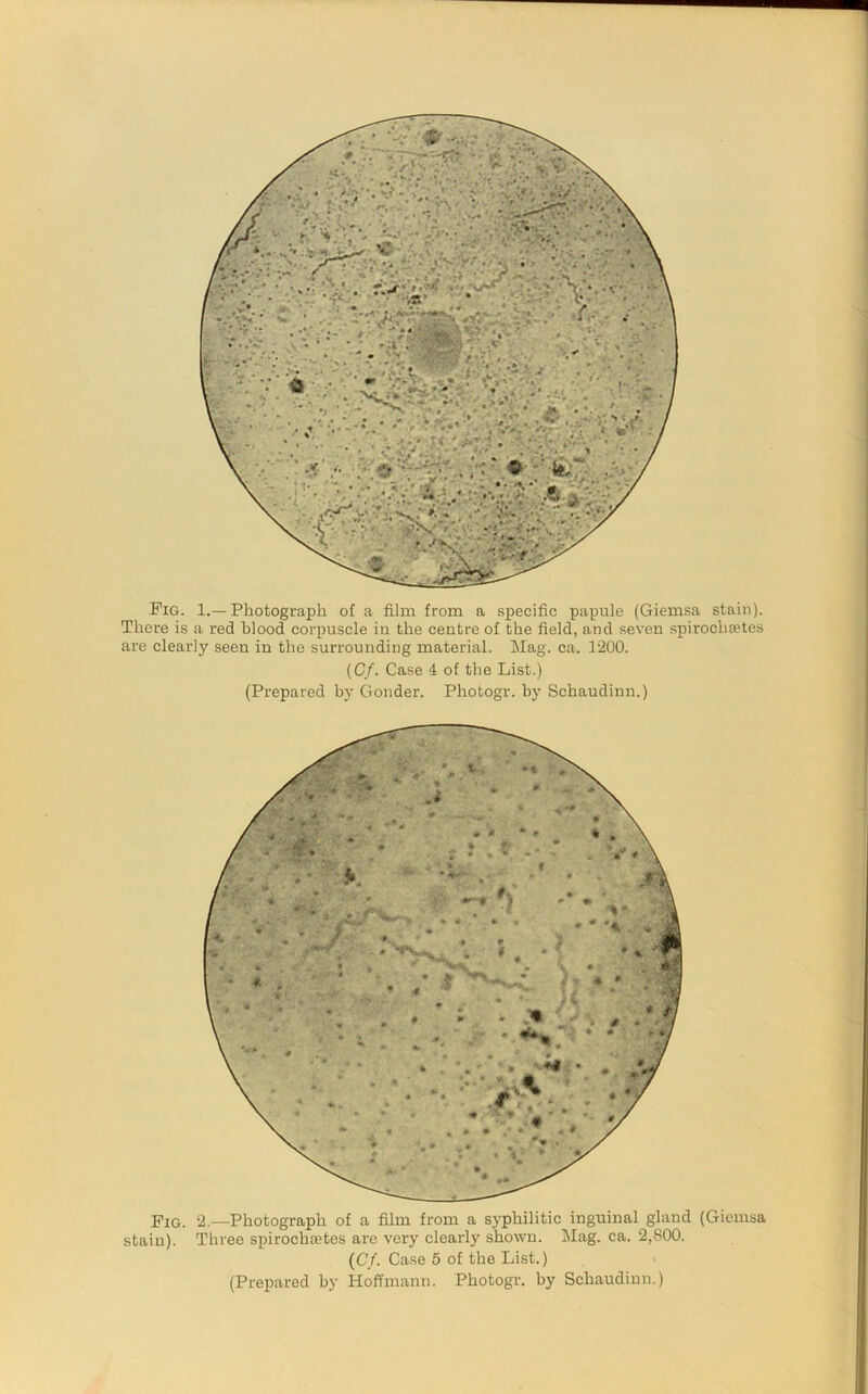 Fig. 1.—Photograph of a film from a specific papule (Giemsa stain). There is a red blood corpuscle in the centre of the field, and seven spirochtetes are clearly seen in the surrounding material. Mag. ca. 1200. (C/. Case 4 of the List.) (Prepared by Gonder. Photogr. by Schaudinn.) Pig. 2.—Photograph of a film from a syphilitic inguinal gland (Giemsa stain). Three spirochsetes are very clearly shown. Mag. ca. 2,800. {Cf. Case 5 of the List.) (Prepared by Hoffmann. Photogr. by Schaudinn.)