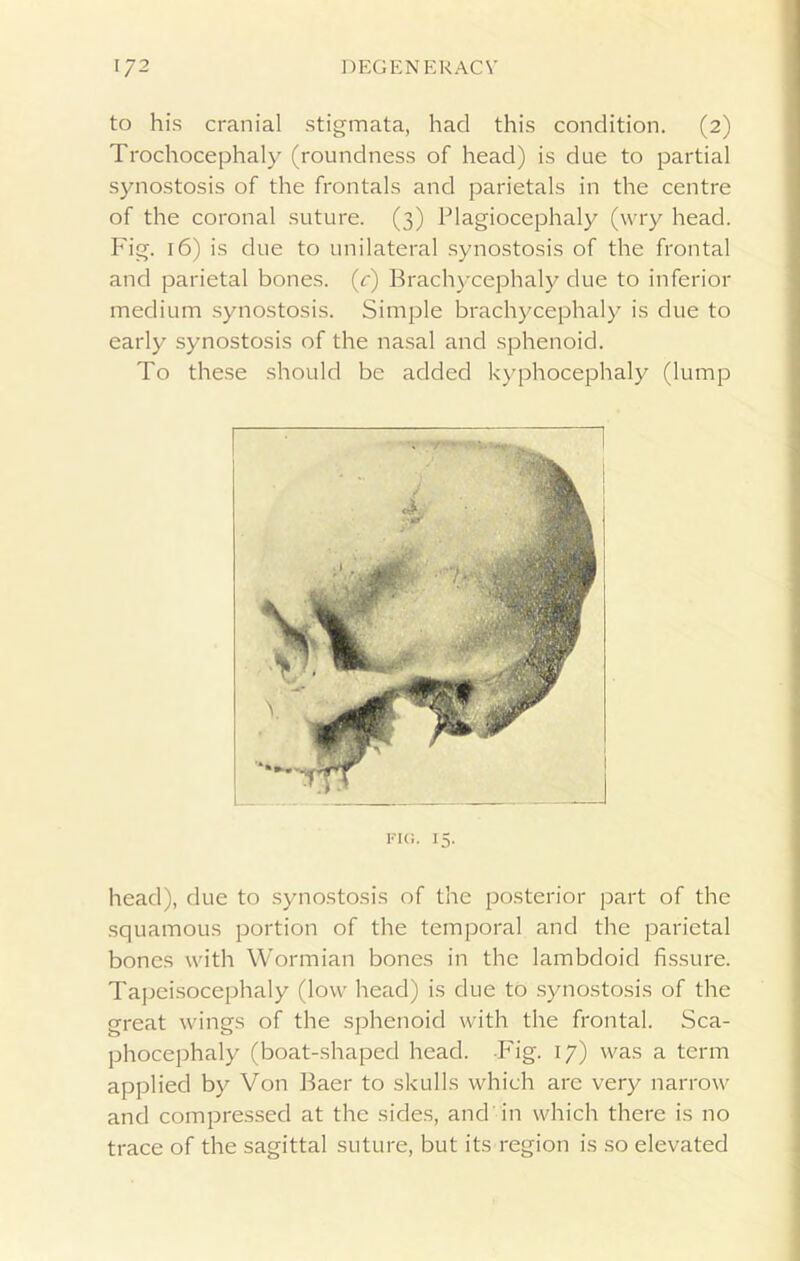 to his cranial stigmata, had this condition. (2) Trochocephaly (roundness of head) is due to partial synostosis of the frontals and parietals in the centre of the coronal suture. (3) Plagiocephaly (wry head. Fig. 16) is due to unilateral synostosis of the frontal and parietal bones, (c) Brachycephaly due to inferior medium synostosis. Simple brachycephaly is due to early synostosis of the nasal and sphenoid. To these should be added kyphocephaly (lump Fi«- 15- head), due to synostosis of the posterior part of the squamous portion of the temporal and the parietal bones with Wormian bones in the lambdoid fissure. Tapeisocephaly (low head) is due to synostosis of the great wings of the sphenoid with the frontal. Sca- phocephaly (boat-shaped head. Fig. 17) was a term applied by Von Baer to skulls which are very narrow and compressed at the sides, and in which there is no trace of the sagittal suture, but its region is so elevated