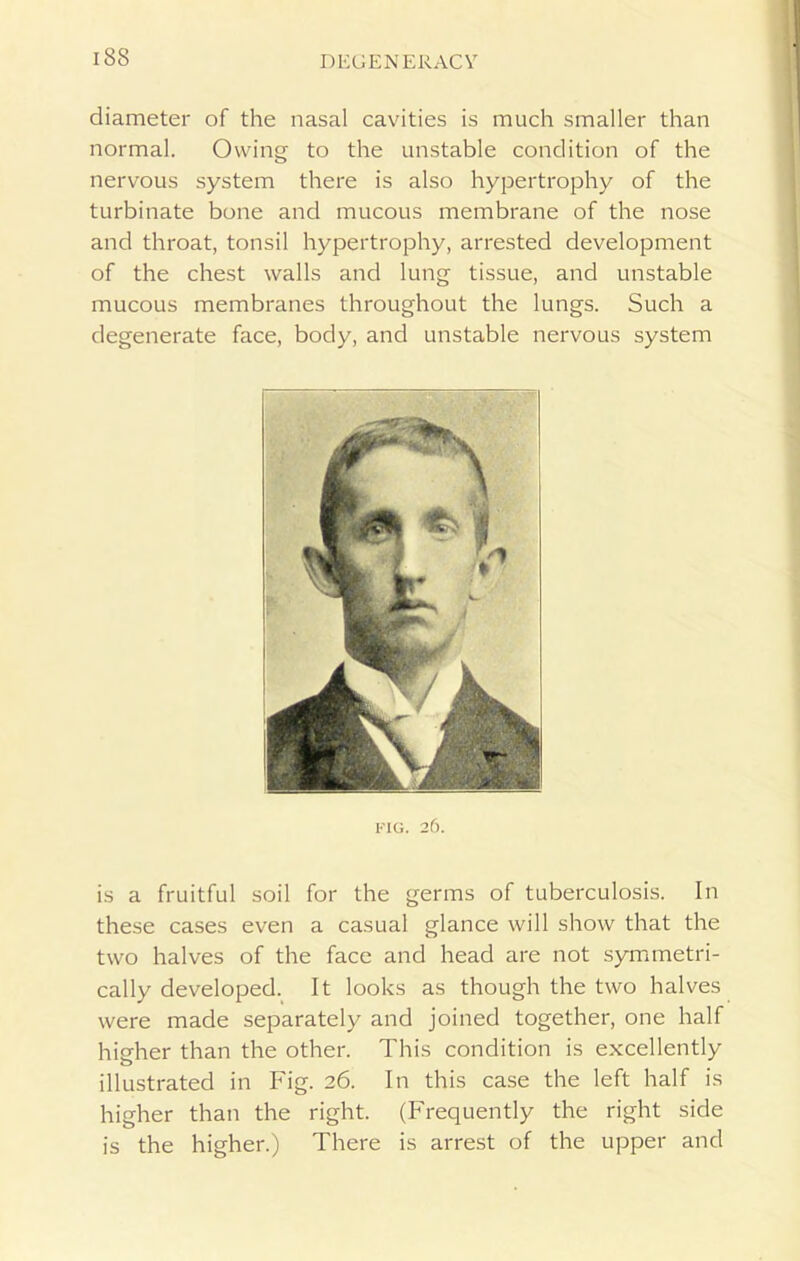 diameter of the nasal cavities is much smaller than normal. Owing to the unstable condition of the nervous system there is also hypertrophy of the turbinate bone and mucous membrane of the nose and throat, tonsil hypertrophy, arrested development of the chest walls and lung tissue, and unstable mucous membranes throughout the lungs. Such a degenerate face, body, and unstable nervous system FIG. 26. is a fruitful soil for the germs of tuberculosis. In these cases even a casual glance will show that the two halves of the face and head are not symmetri- cally developed. It looks as though the two halves were made separately and joined together, one half hierher than the other. This condition is excellently illustrated in Fig. 26. In this case the left half is higher than the right. (Frequently the right side is the higher.) There is arrest of the upper and