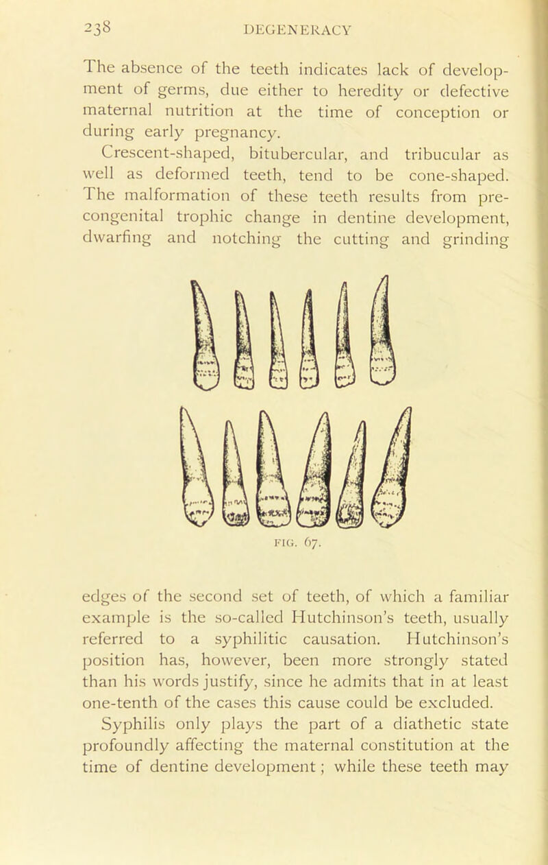 The absence of the teeth indicates lack of develop- ment of germs, due either to heredity or defective maternal nutrition at the time of conception or during early pregnancy. Crescent-shaped, bitubercular, and tribucular as well as deformed teeth, tend to be cone-shaped. The malformation of these teeth results from pre- congenital trophic change in dentine development, dwarfing and notching the cutting and grinding fig. 67. edges of the second set of teeth, of which a familiar example is the so-called Hutchinson’s teeth, usually referred to a syphilitic causation. Hutchinson’s position has, however, been more strongly stated than his words justify, since he admits that in at least one-tenth of the cases this cause could be excluded. Syphilis only plays the part of a diathetic state profoundly affecting the maternal constitution at the time of dentine development; while these teeth may