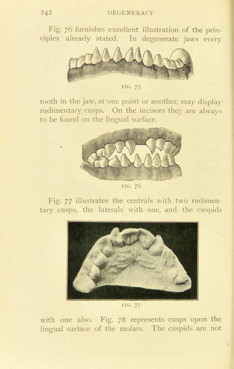 Fig. 76 furnishes excellent illustration of the prin- ciples already stated. In degenerate jaws every fig. 75. tooth in the jaw, at one point or another, may display rudimentary cusps. On the incisors they are always to be found on the lingual surface. FIG. 76. Fig. 77 illustrates the centrals with two rudimen- tary cusps, the laterals' with one, and the cuspids fig. 77. with one also. Fig. 78 represents cusps upon the lingual surface of the molars. The cuspids are not