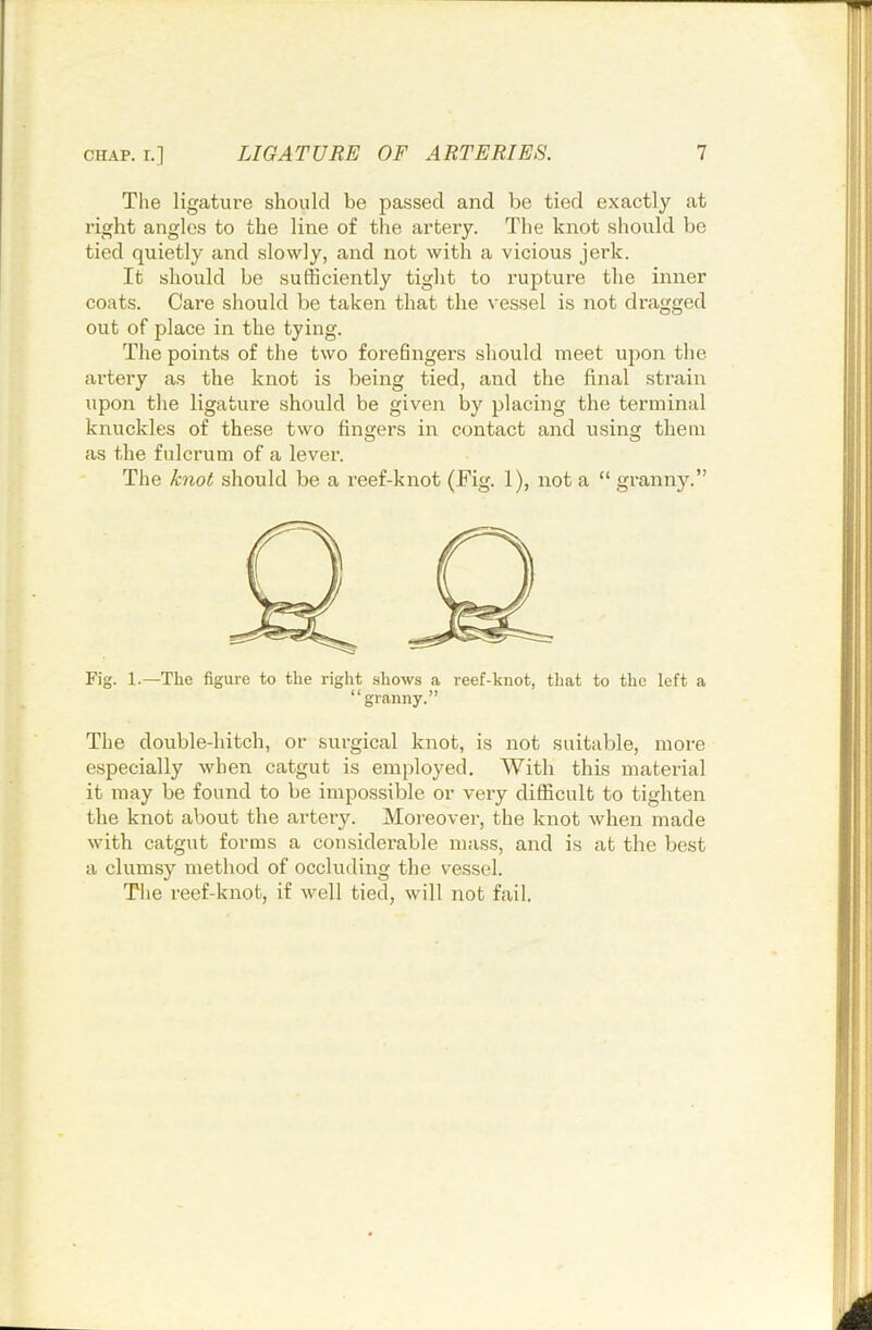 The ligature should be passed and be tied exactly at right angles to the line of the artery. The knot should be tied quietly and slowly, and not with a vicious jei’k. It should be sufficiently tiglit to rupture the inner coats. Care should be taken that the vessel is not dragged out of place in the tying. The points of the two forefingers should meet upon the artery as the knot is being tied, and the final strain upon the ligature should be given by placing the terminal knuckles of these two fingers in contact and using them as the fulcrum of a lever. The knot should be a reef-knot (Fig. 1), not a “ granny.” Fig. 1.—The figure to the right shows a reef-knot, that to the left a “granny.” The double-hitch, or surgical knot, is not suitable, more especially when catgut is employed. With this material it may be found to be impossible or very difficult to tighten the knot about the artery. Moi-eover, the knot when made with catgut forms a considerable mass, and is at the best a clumsy method of occluding the vessel. Tlie I’eef-knot, if well tied, will not fail.