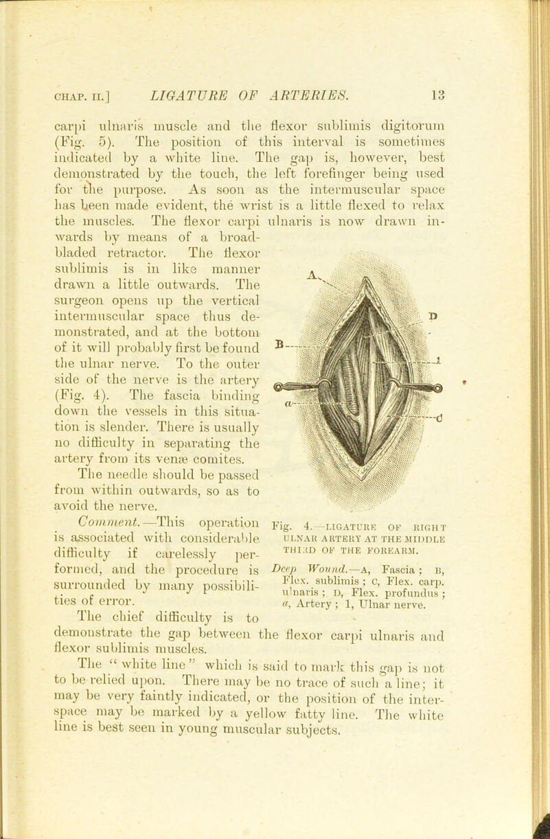 carpi uliiarls muscle and tlie flexor sublimis cligitorum (Fig. 5). The jiosition of this interval is sometimes indicated by a white line. The gap is, however, best demonstrated by the touch, the left forefinger being used for tlie purpose. As soon as the intermuscular space has been made evident, the wrist is a little flexed to relax the muscles. The flexor carpi ulnaris is now drawn in- wards by means of a broad- bladed reti’actor. The flexor sublimis is in like manner drawn a little outwards. The surgeon opens up the vertical intermuscular space thus de- monsti-ated, and at the bottom of it will probably first be found the ulnar nerve. To the outer side of the nerve is the artery (Fig. 4). The fascia binding down the vessels in this situa- tion is slender. There is usually no difficulty in separating the artery from its ven^e comites. The needle should be passed from within outwards, so as to avoid the nerve. Comment. —This operation is associated with considerat)le difficulty if carelessly per- formed, and the procedure is surroumled by many possibili- ties of error. The chief difficulty is to demonstrate tlie gap between the flexor carpi ulnaris and flexor sublimis muscle.s. The “ white line ” which is said to mark this gaj) is not to be relied upon. There may be no trace of such a line; it may be very faintly indicated, or the position of the inter- space may be marked by a yellow fatty line. The white line is best seen in young muscular subjects. Fig. 4.—UGATCUE or uight Ur.VAli AKTEUY AT THE MIDDLE THi;iD or THE rOUEAUM. Dcejt Wound.—a. Fascia ; B, Flex, sublimis ; C, Flex. carj). ulnaris ; d, Flex, profundus ; a. Artery ; 1, Ulnar nerve.