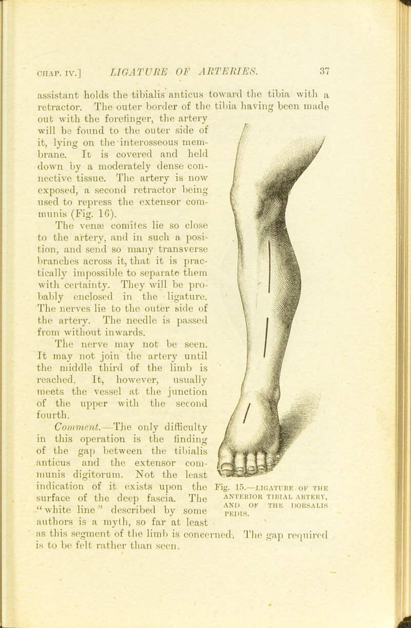 assistant holds the tibialis anticus toward the tibia with a retractor. The outer border of the tibia having been made out with the forefinger, the artery will be found to the outer side of it, lying on the interosseous mem- brane. It is covered and held down by a moderately dense con- nective tissue. The artery is now exposed, a second retractor being used to repress the extensor com- munis (Fig. IG). The veme comites lie so close to the artery, and in such a posi- tion, and send so many transverse 1 (ranches across it, that it is prac- tically impossible to .separate them with certainty. They will be pro- bably enclosed in the ligature. The nerves lie to the outer side of the artery. The needle is passed from without inwards. The neiwe may not be seen. It may not join the artery until the middle third of the limb is reached. It, however, usually meets the vessel at the junction of the upper with the second fourth. Comment.—TJie only difficulty in this operation is the finding of the gap between the tiljialis anticus and the extensor com- munis digitoruin. Not the least indication of it exists upon the surface of the deep fascia. The “white line” described by some authors is a myth, so far at least as this segment of the limb is concerned, d'he gap required is to be felt ratber than seen. Fig. 15.—J.TG.MTKE or THE ANTEUIOU TIBIAL AKTEHY, AND or THE DOUSAUS PEDIS.