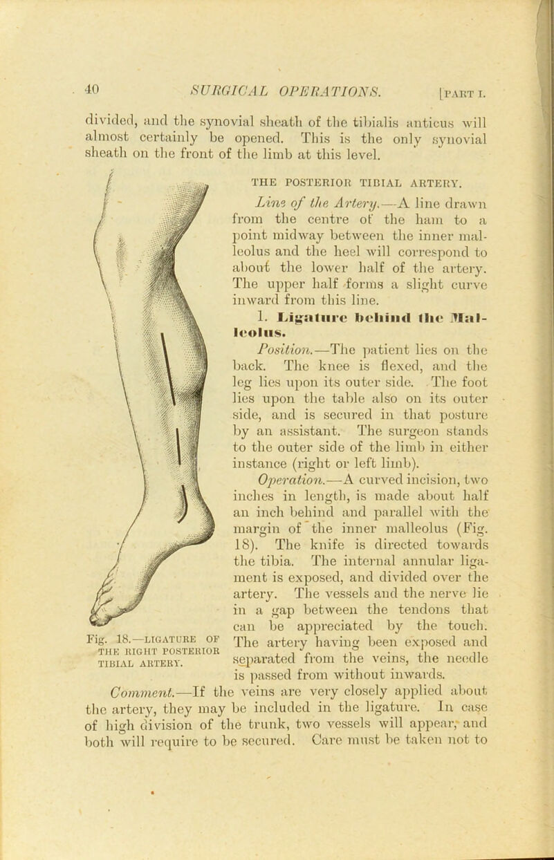 divided, and the synovial sheath of the tiltialis anticus will almost certainly be opened. This is the only synovial sheath on the front of the limb at this level. THE POSTERIOR TIBIAL ARTERY. Line of the Artery,—A line drawn from the centre of the ham to a point midway between the inner mal- leolus and the heel will correspond to about the lower half of the artery. The upper half dorms a slight curve inward from this line. 1. f..i;{::iliire lu'liiiid lli<‘ iVIal- leoliis. Position.—The patient lies on the back. The knee is flexed, and the leg lies upon its outer side. The foot lies upon the table also on its outer side, and is secured in that posture by an assistant. The surgeon stands to the outer side of the limb in either instance (right or left limb). Oiieration.—A curved incision, two inches in length, is made about half an inch behind and parallel with the margin of the inner malleolus (Fig. 18). The knife is directed towards the tibia. The internal annular liga- ment is exposed, and divided over the artery. Tlie vessels and the nerve lie in a gap between the tendons that can be ajipi-eciated by the touch. Fig. 18.—LIGATURE OF artery having been e.xposed and THE RIGHT POSTERIOR , , % ,P . \ „ TIBIAL ARTERY. sepai’atcd from the veins, tlie needle is passed from without inwards. Comment.—the veins are very closely applied about the artery, they may be included in the ligature. In case of high division of the trunk, two vessels will appear,' and both will require to be secured. Care must be taken not to