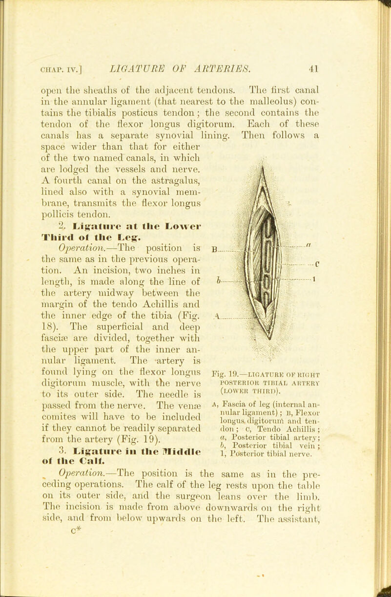open tlie sheaths of the adjacent tendons. The linst canal in the annular ligament (that nearest to the malleolus) con- tains the tibialis posticus tendon; the second contains the tendon of the He.xor longus digitorum canals has a separate synovial linin space wider than that for either of the two named canals, in which are lodged the vessels and nerve. A fourth canal on the astragalus, lined also with a synovial mem- brane, transmits the flexor longus pollicis tendon. 2. Li^;:itiii‘o at tlie Lower Tliird of the Leg:. Operation.—The position is the same as in the pi-evious o})era- tion. An incision, two inches in length, is made along the line of the artery midway between the mai-gin of the tendo Achillis and the inner edge of the tibia (Fig. 18). The superficial and deep fascim are divided, together with the upper part of the inner an- nular ligament. The artery is found lying on the flexor longus digitorum muscle, with the nerve to its outer side. The needle is passed from the nerve. The vente comites will have to be included if they cannot be readily separated from the artery (Fig. 19). 3. Ligature in the lYlitldle ot tlie Calf. Each of these Then follows a Fig. 1!).—UfiATURK OKKICHT POSTERIOR TIHIAL AUTERV (lower third). A, Fascia of leg (internal an- nular ligament); n, Flexor longus, iligitorun'i and ten- don ; C, Tendo Achillis; «, Posterior tibial artery; h. Posterior tibial vein; 1, Posterior tibial nerve. Operation.—The position is the same as in the pre- ceding operations. The calf of the leg rests upon the table on its outer side, and the surgeon leans over the limb. The incision is made from above downwards on the right side, and from below upwards on the left. The assistant,