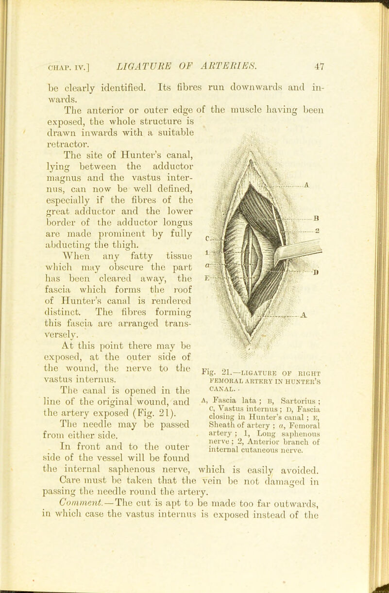 identified. Its fibres run downwards and iii- or outer edge of the muscle liaving been be clearly wards. The anterior exposed, the whole structure is drawn inwards with a suitable rctractoi’. The site of Hunter’s canal, l3dng between the adductor magnus and the vastus inter- ims, can now be well defined, especially if the fibres of the great adductor and the lower border of the adductor lonsjus are made prominent by fully abductin the thih. When any fatty tissue wliich may obscure the part has been cleared away, the fascia which forms the I'oof of Hunter’s canal is rendered distinct. The fibres formins: this fascia are Versely. At this point there may be exposed, at the outer side of tlie wound, the nerve to the vastus internus. Tlie canal is opened in the line of the original wound, and the artery exposed (Fig. 21). The needle may be passed from either side. In front and to the outer side of the vessel will be found the internal saphenous nerve, which is easily avoided. Care must be taken that the vein be not passing tlie needle round the artery. Comment. —'T\\q cut is apt to be made too far outwards, in which case the vastus internus is exposed instead of the arranged trans- Fig. 21.—LIGATURE or RIGHT FEMORAL ARTERY IN HUNTEIl’S CANAL. ■ A, Fascia lata ; b, Sartorius ; c, Vastus internus ; n, Fascia closing in Hunter’s canal; e, Sheath of artery ; «, Femoral artery ; 1, Long sai)henous nerve ; 2, Anterior branch of internal cutaneous nerve. damaod O in