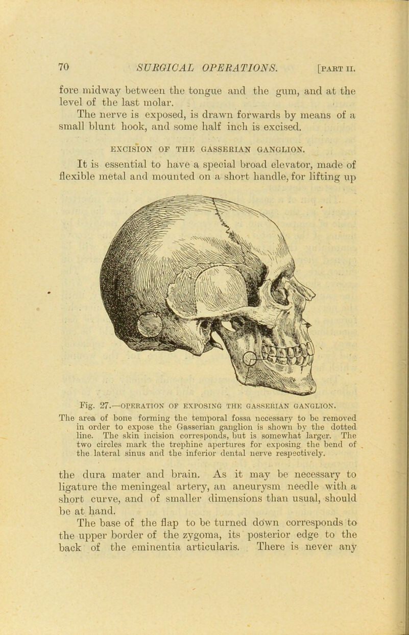 fore midway between the tongue and tlie gum, and at the level of the last molar. The nerve is exposed, is drawn forwards by means of a small blunt hook, and some half inch is excised. EXCISION OF THE GASSERIAN GANGLION. It is essential to have a special broad elevator, made of flexible metal and mounted on a short handle, for lifting up Fig. 27.—OPERATION OF EXPOSING THE GASSERIAN GANGLIO.N. The area of bone forming the temporal fossa necessary to be removed in order to expose the Gasserian ganglion is shown by the dotted line. The skin incision corresponds, but is somewhat larger. The two circles mark the trephine apertures for exposing tlie bend of , the lateral sinus and the inferior dental nerve respectively. the dura mater and brain. As it may be necessaiy to ligature the meningeal artery, an aneurysm needle with a short curve, and of smaller dimensions than usual, should be at hand. The base of the flap to be turned down corresponds to the upper border of the zygoma, its posterior edge to the back of the eminentia articularis. There is never any