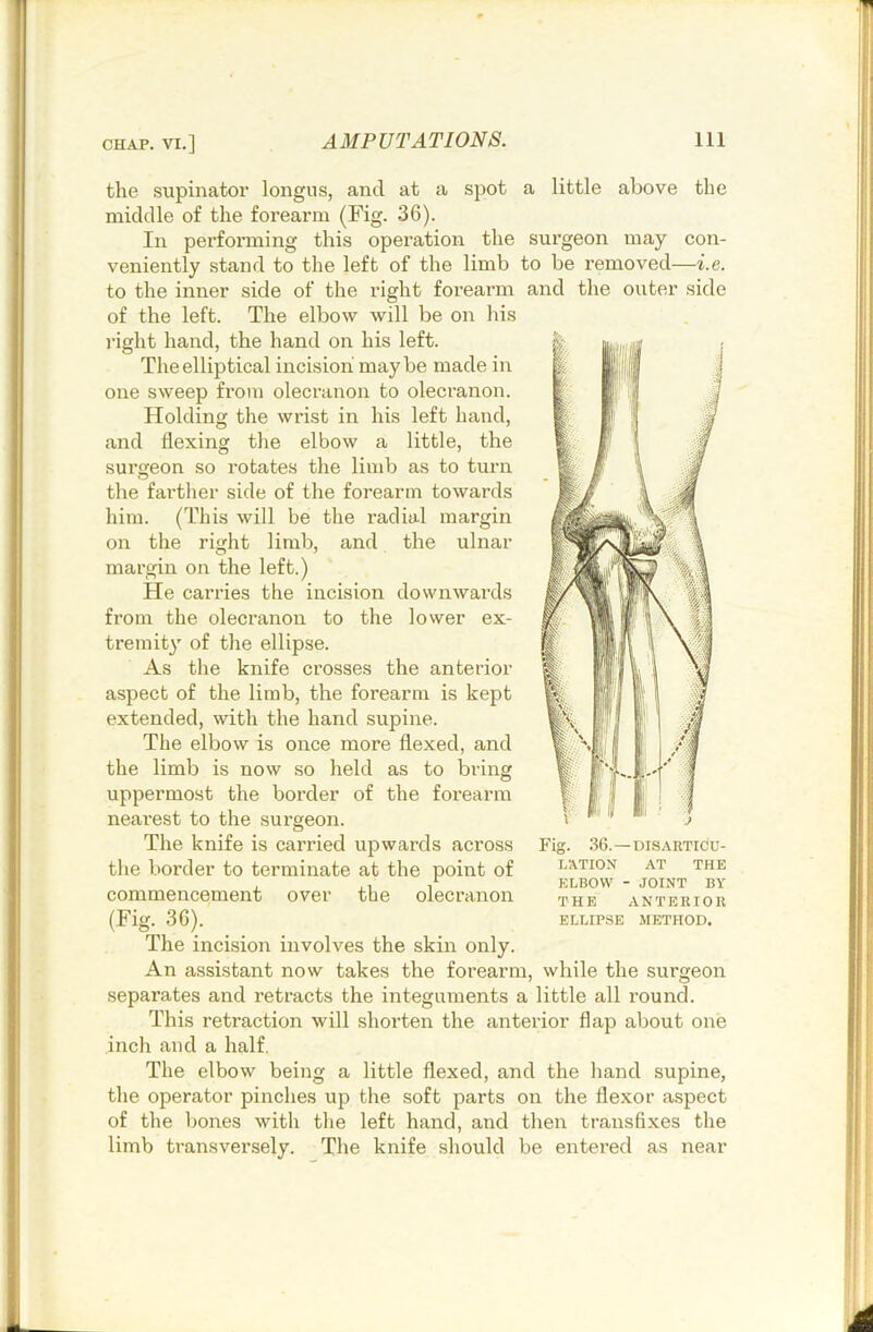 the supinator longus, and at a spot a little above the middle of the forearm (Fig. 36). In perfoiTuing this operation the surgeon may con- veniently stand to the left of the limb to be removed—i.e. to the inner side of the light forearm and the outer side of the left. The elbow will be on his light hand, the hand on his left. The elliptical incision maybe made in one sweep from olecranon to olecranon. Holding the wrist in his left hand, and flexing the elbow a little, the surgeon so rotates the limb as to turn the farther side of the forearm towards him. (This will be the radial margin on the right limb, and the ulnar margin on the left.) He carries the incision downwards from the olecranon to the lower ex- tremity of the ellipse. As the knife crosses the anterior aspect of the limb, the forearm is kept extended, with the hand supine. The elbow is once more flexed, and the limb is now so held as to bring uppermost the border of the forearm neai'est to the surgeon. Fig. .36. —DISARTICU- I/ATIOX AT THE ELBOW - JOINT BY THE ANTERIOR ELLIPSE METHOD. The knife is carried upwards across the border to terminate at the point of commencement over the olecranon (Fig. 36). The incision involves the skin only. An assistant now takes the forearm, while the surgeon separates and retracts the integuments a little all round. This retraction will shorten the anterior flap about one inch and a half, The elbow being a little flexed, and the hand supine, the operator pinches up the soft parts on the flexor aspect of the liones with the left hand, and then transfixes the limb ti’ansversely. The knife should be entered as near